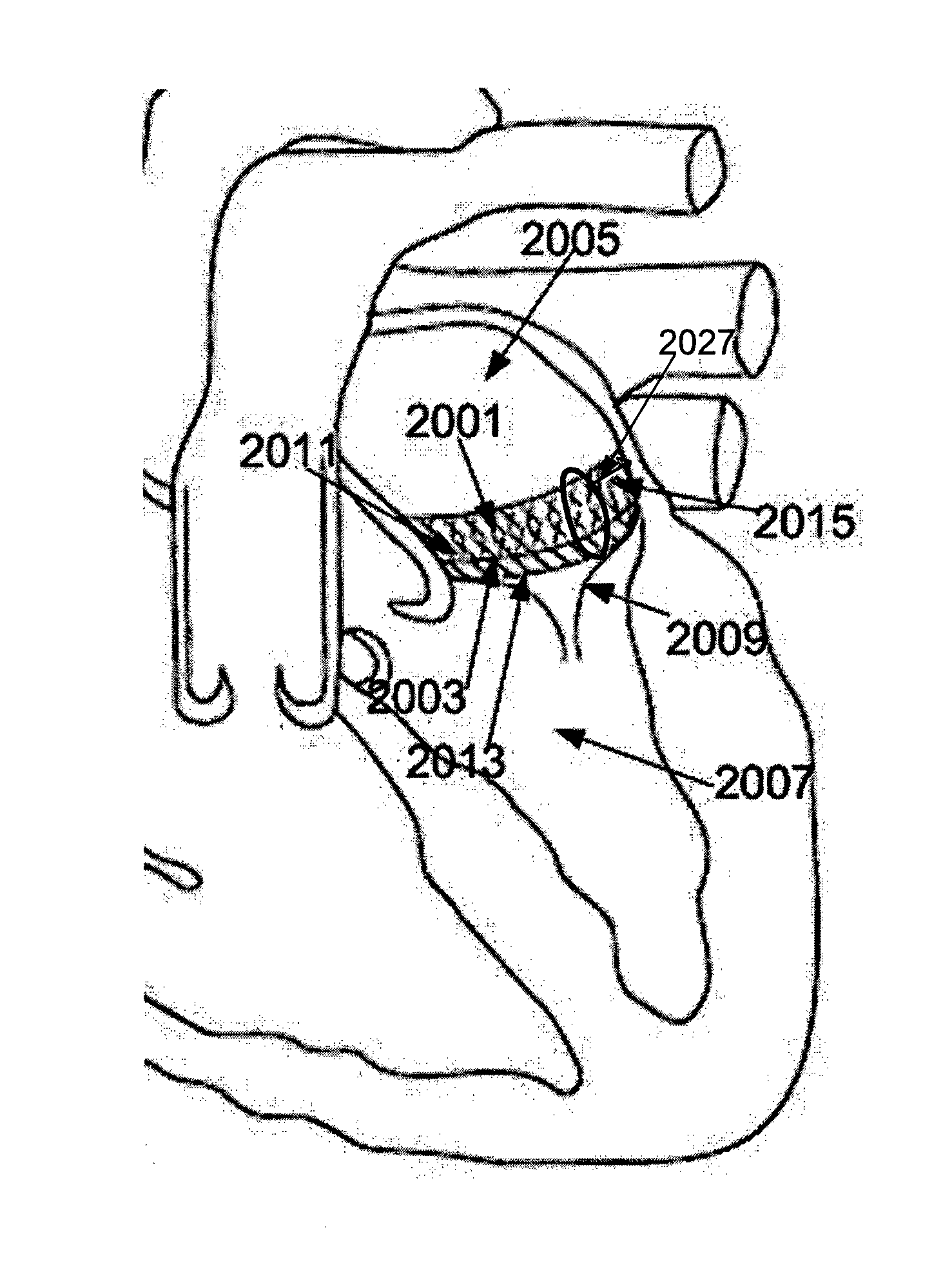 Adjustable annuloplasty apparatus