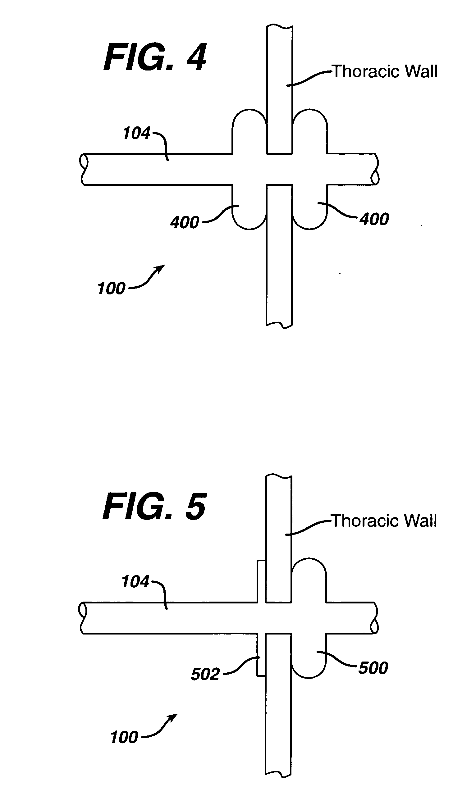 Methods and devices to accelerate wound healing in thoracic anastomosis applications