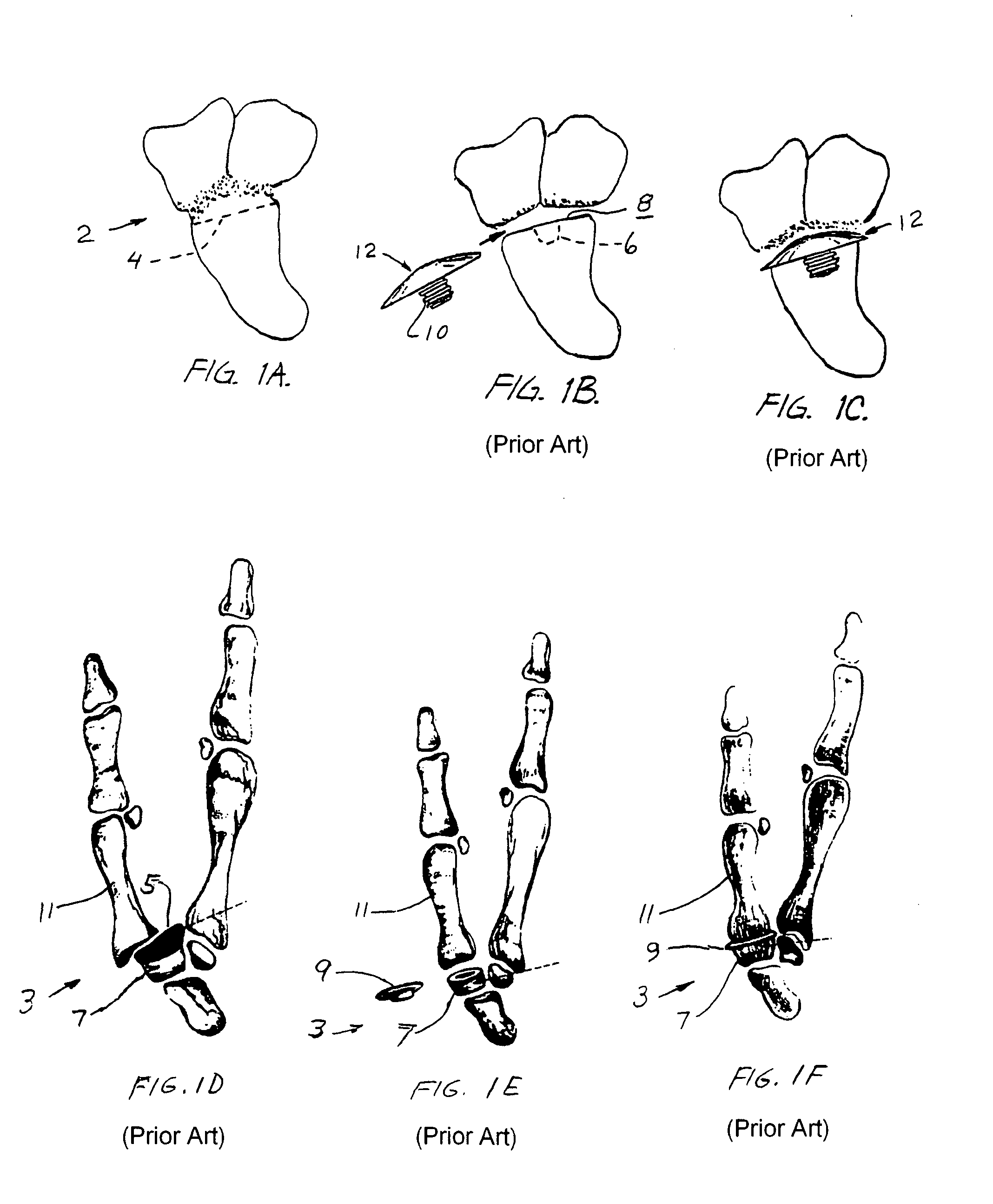 Joint treating method