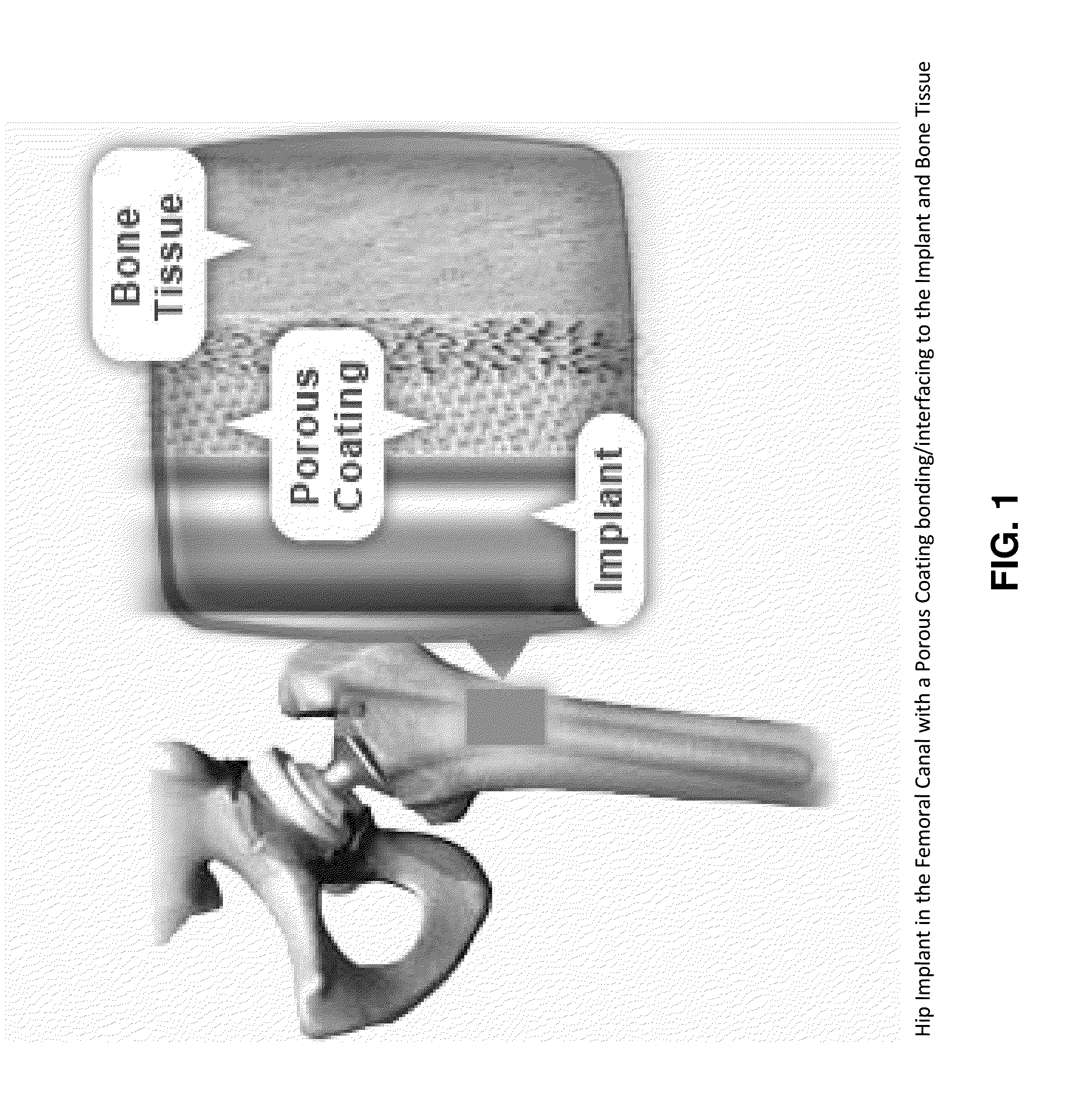 Porous coating for orthopedic implant utilizing porous, shape memory materials