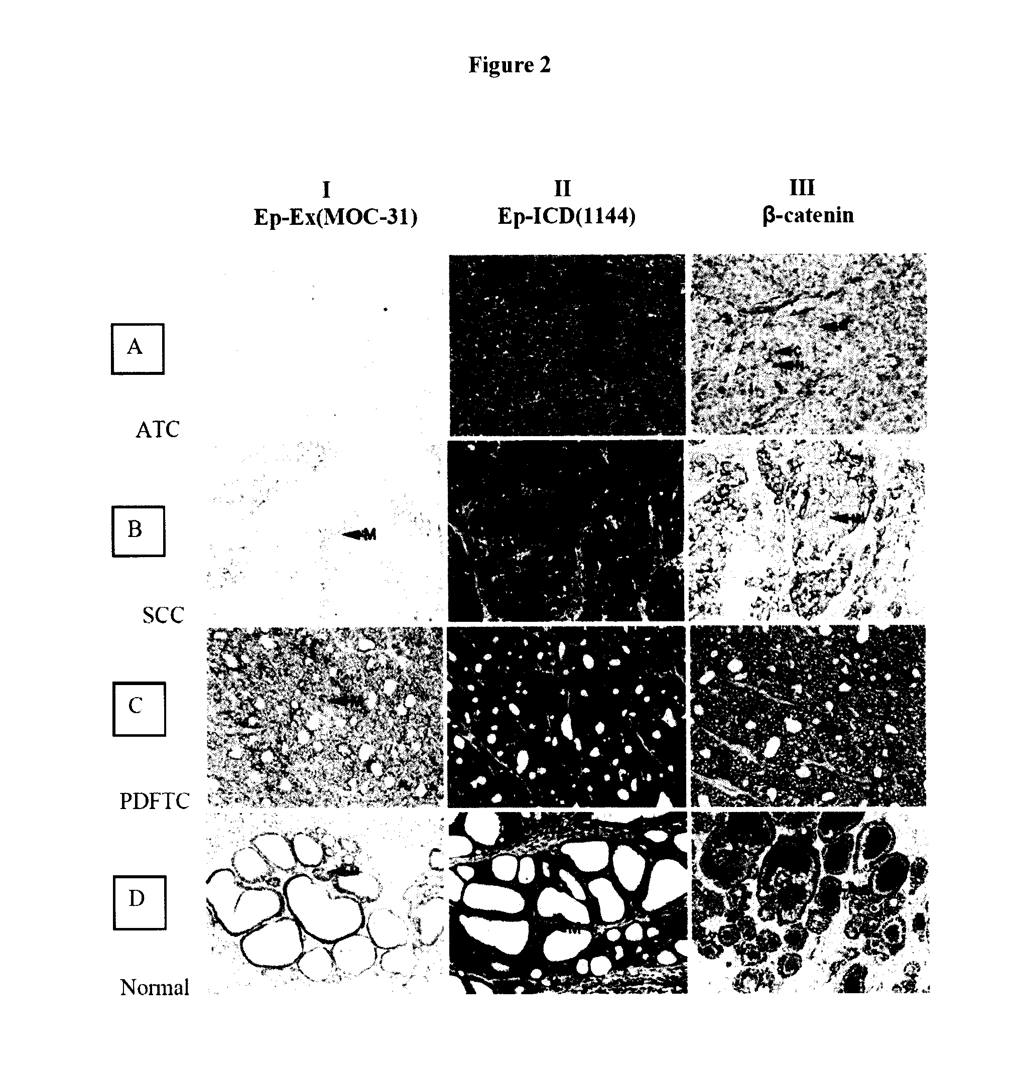 Methods and compositions for the diagnosis and treatment of thyroid cancer