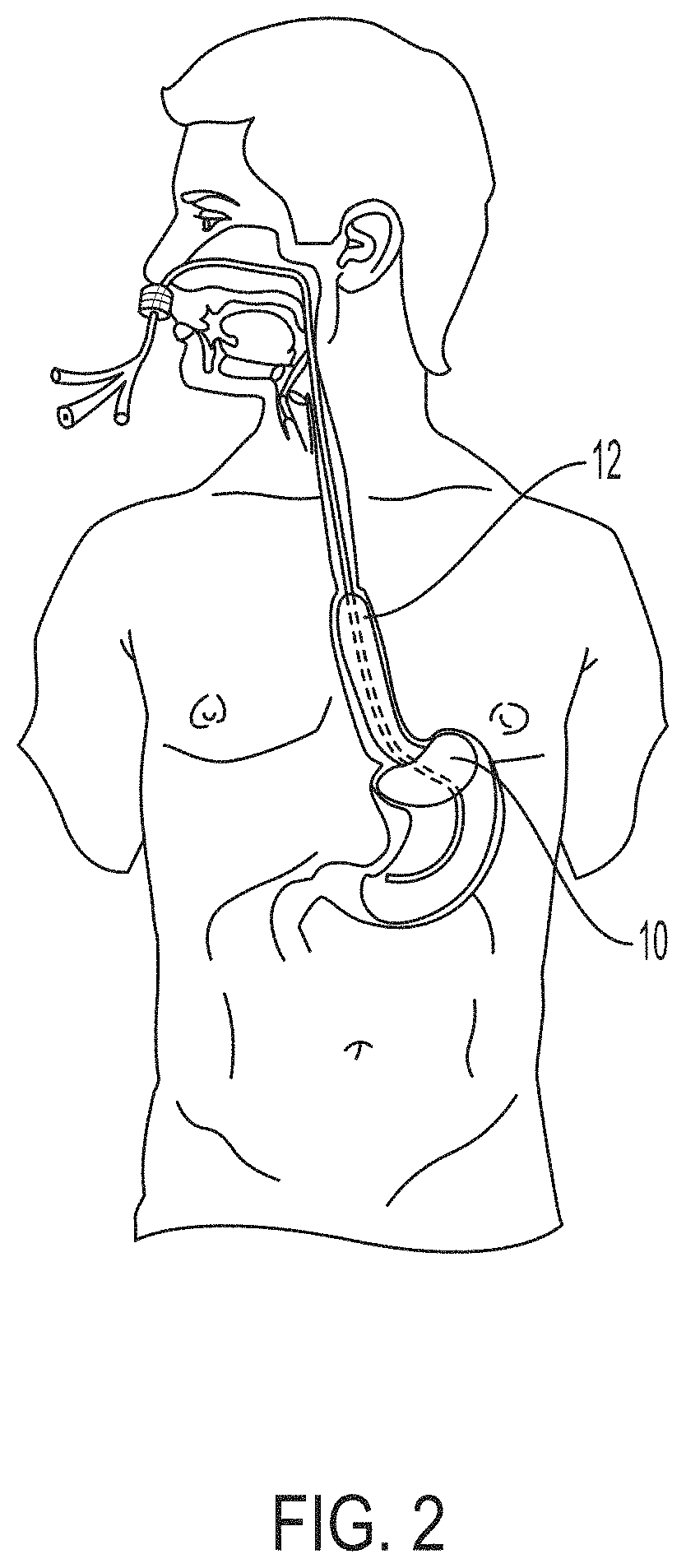 Trans-esophageal aortic flow rate control