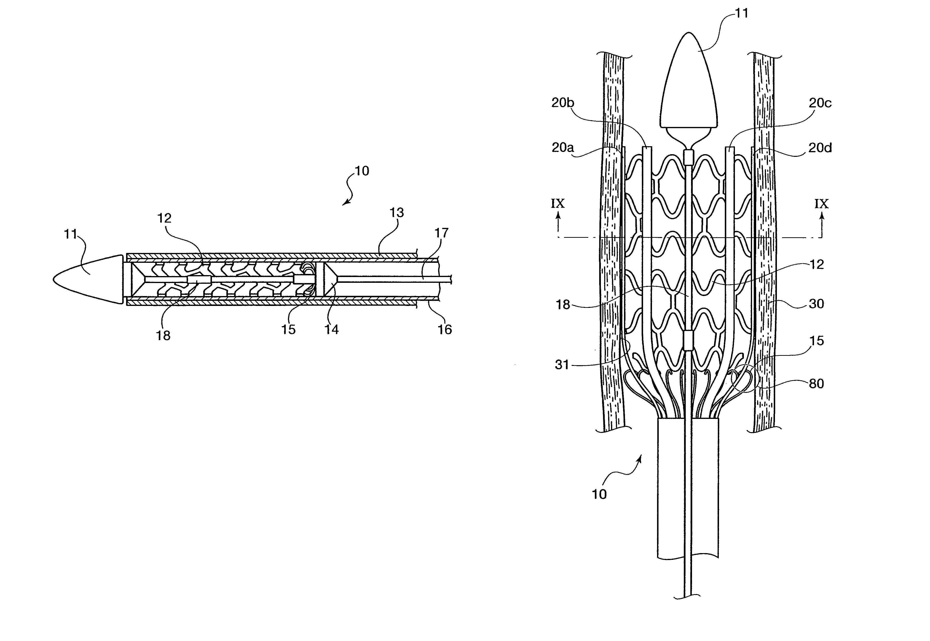 Self-expanding stent and delivery system