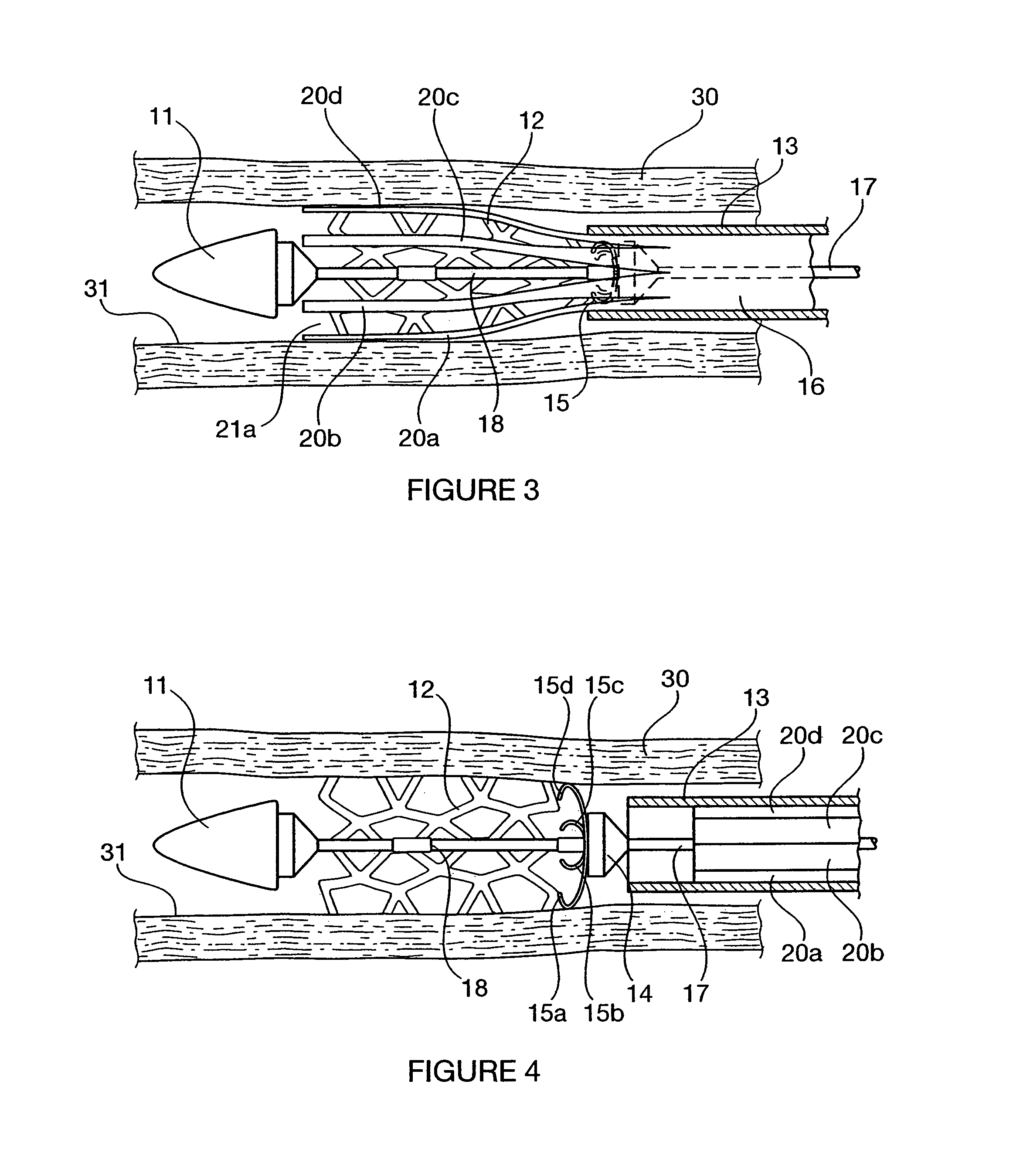 Self-expanding stent and delivery system