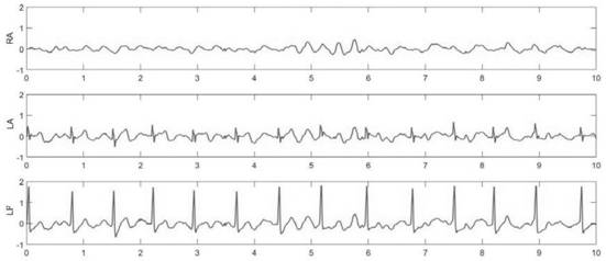 Motion artifact suppression method and twelve-lead wearable electrocardiogram monitoring equipment applying motion artifact suppression method