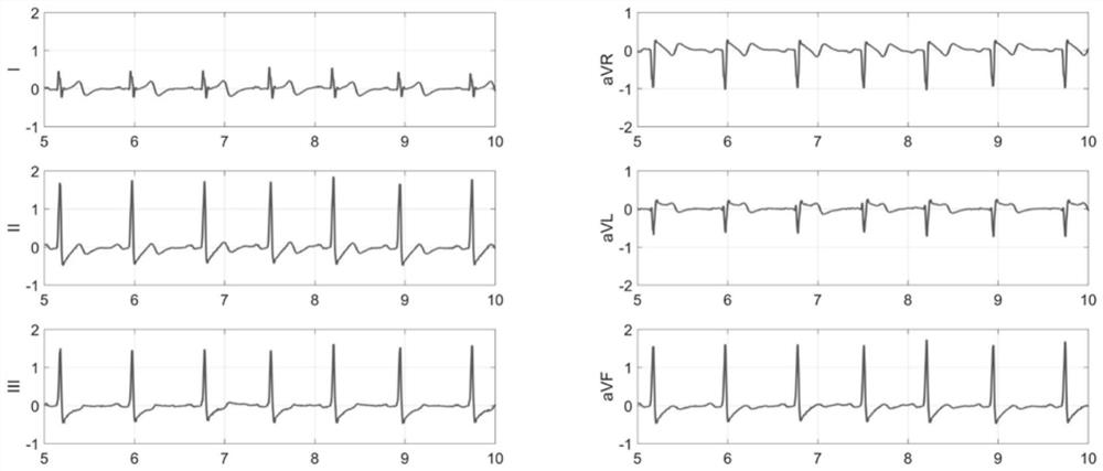 Motion artifact suppression method and twelve-lead wearable electrocardiogram monitoring equipment applying motion artifact suppression method