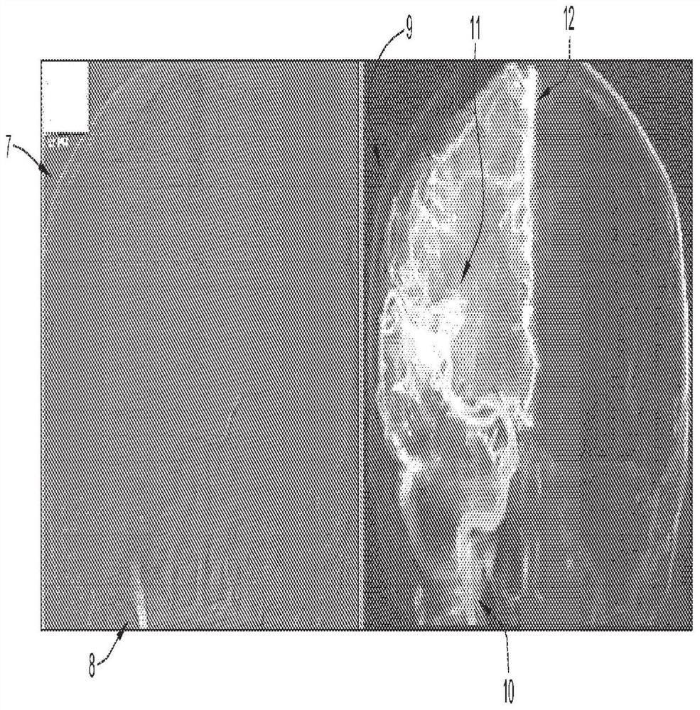 Improved methods for angiography