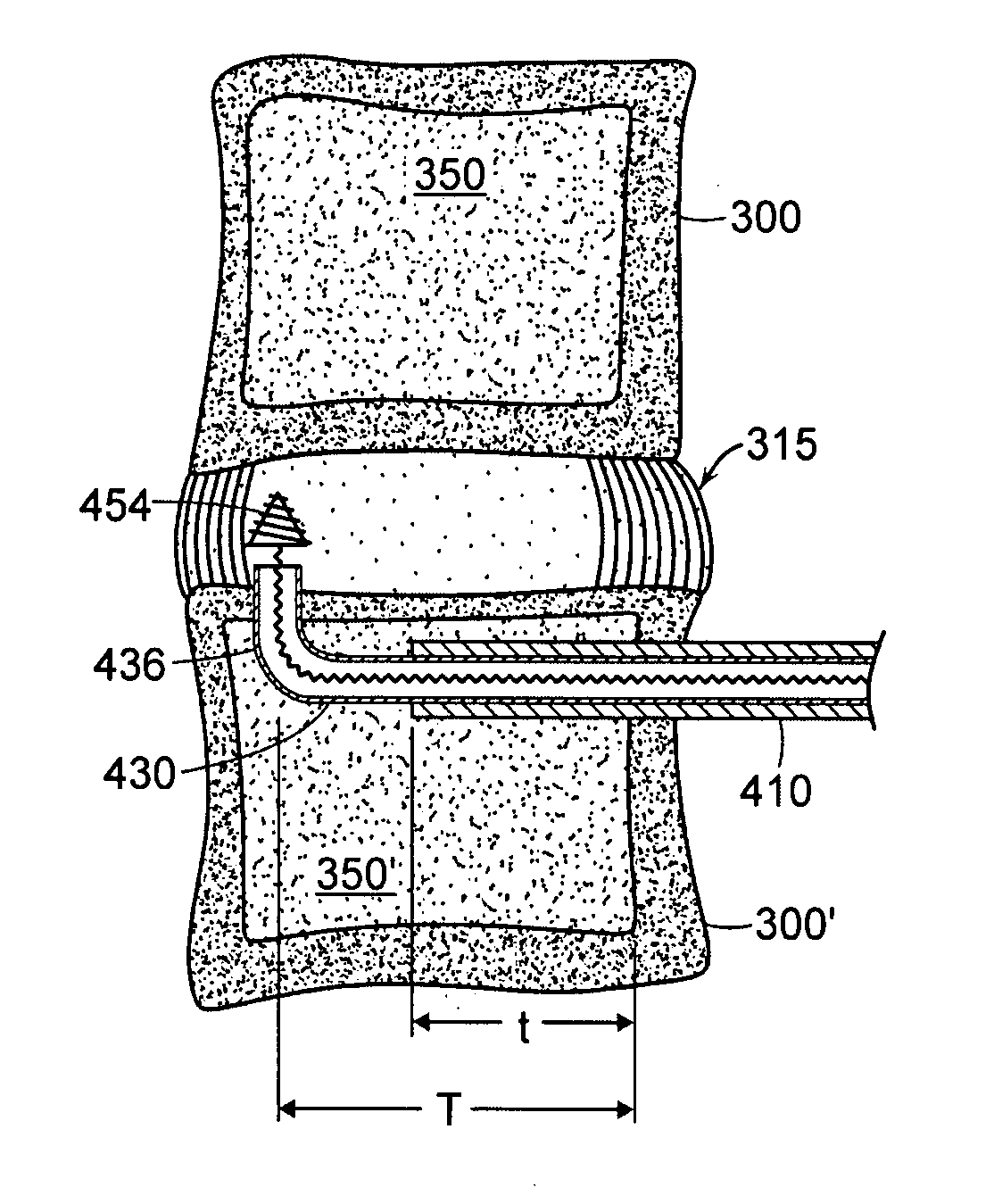 Devices and methods for stabilizing a spinal region