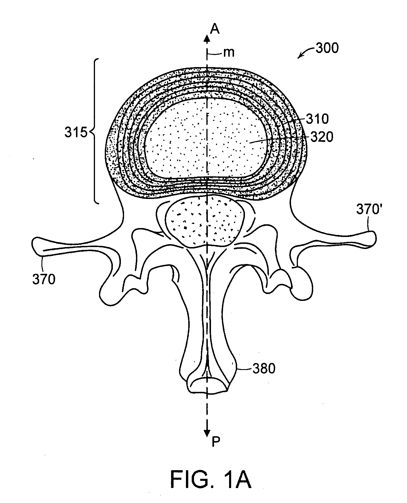 Devices and methods for stabilizing a spinal region