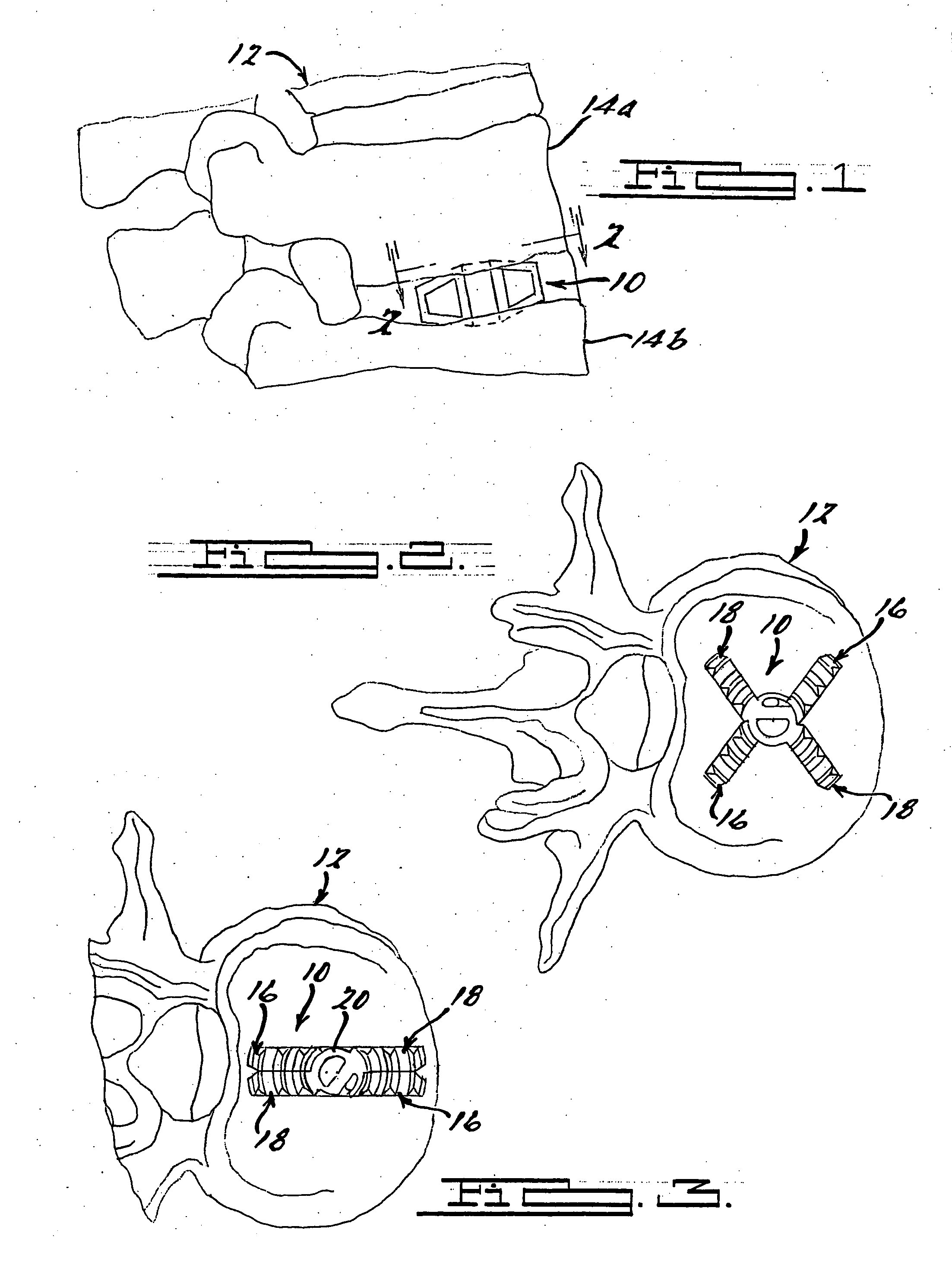 Expandable spinal implant