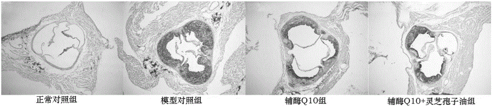 Application of coenzyme Q10 combined ganoderma lucidum spore oil in preparation of antiatherosclerotic drugs