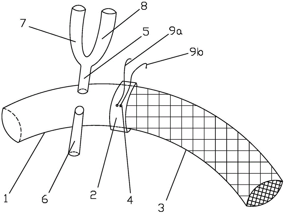 Arcus aortae stent graft vascular structure for department of surgery and application