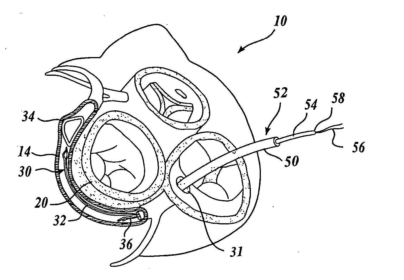 Body lumen device anchor, device and assembly