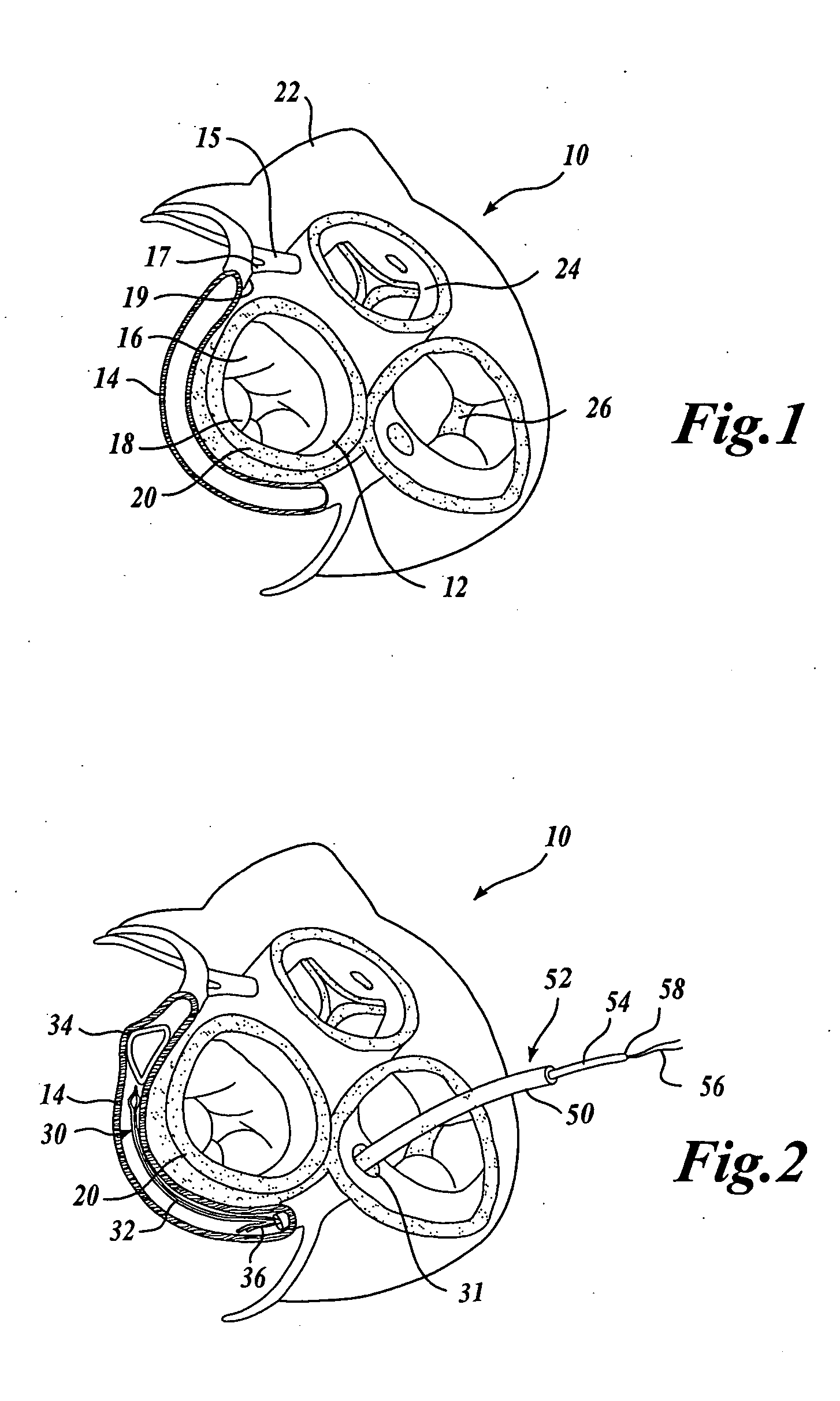 Body lumen device anchor, device and assembly