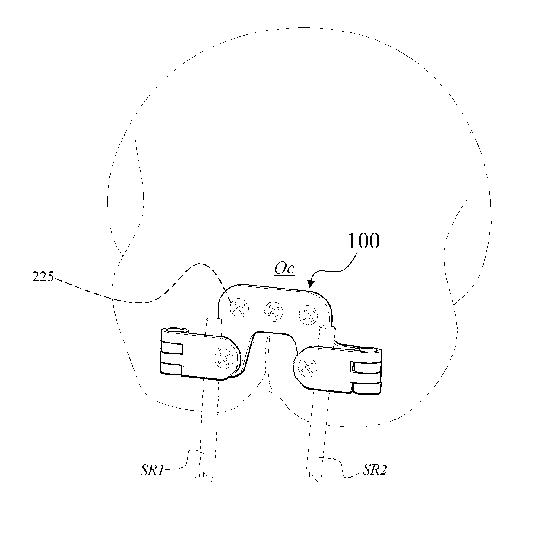 Occipital plate