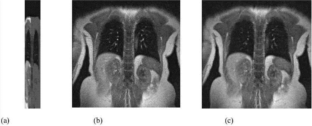 A 4d-mri super-resolution reconstruction method based on dual-dictionary learning