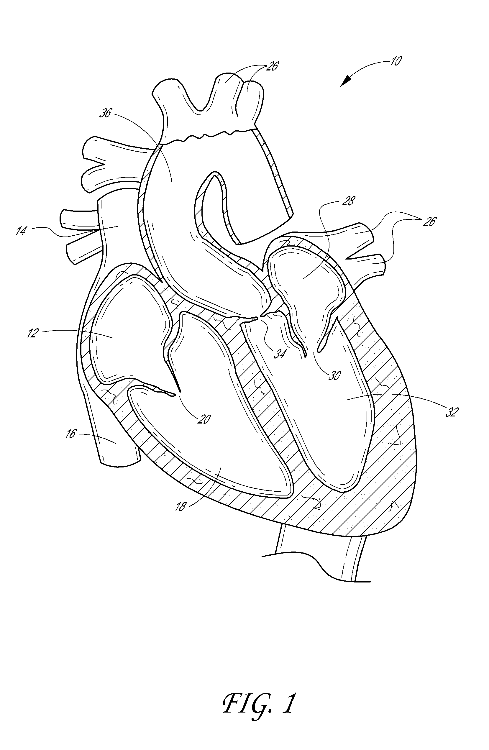 Low crossing profile delivery catheter for cardiovascular prosthetic implant