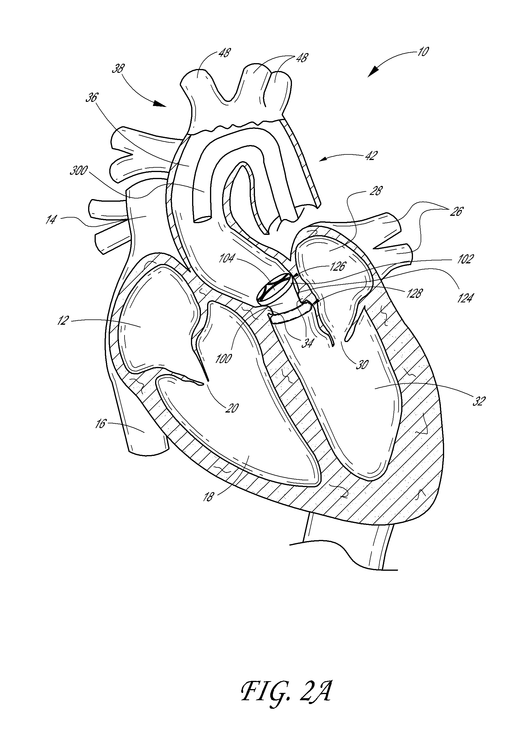 Low crossing profile delivery catheter for cardiovascular prosthetic implant