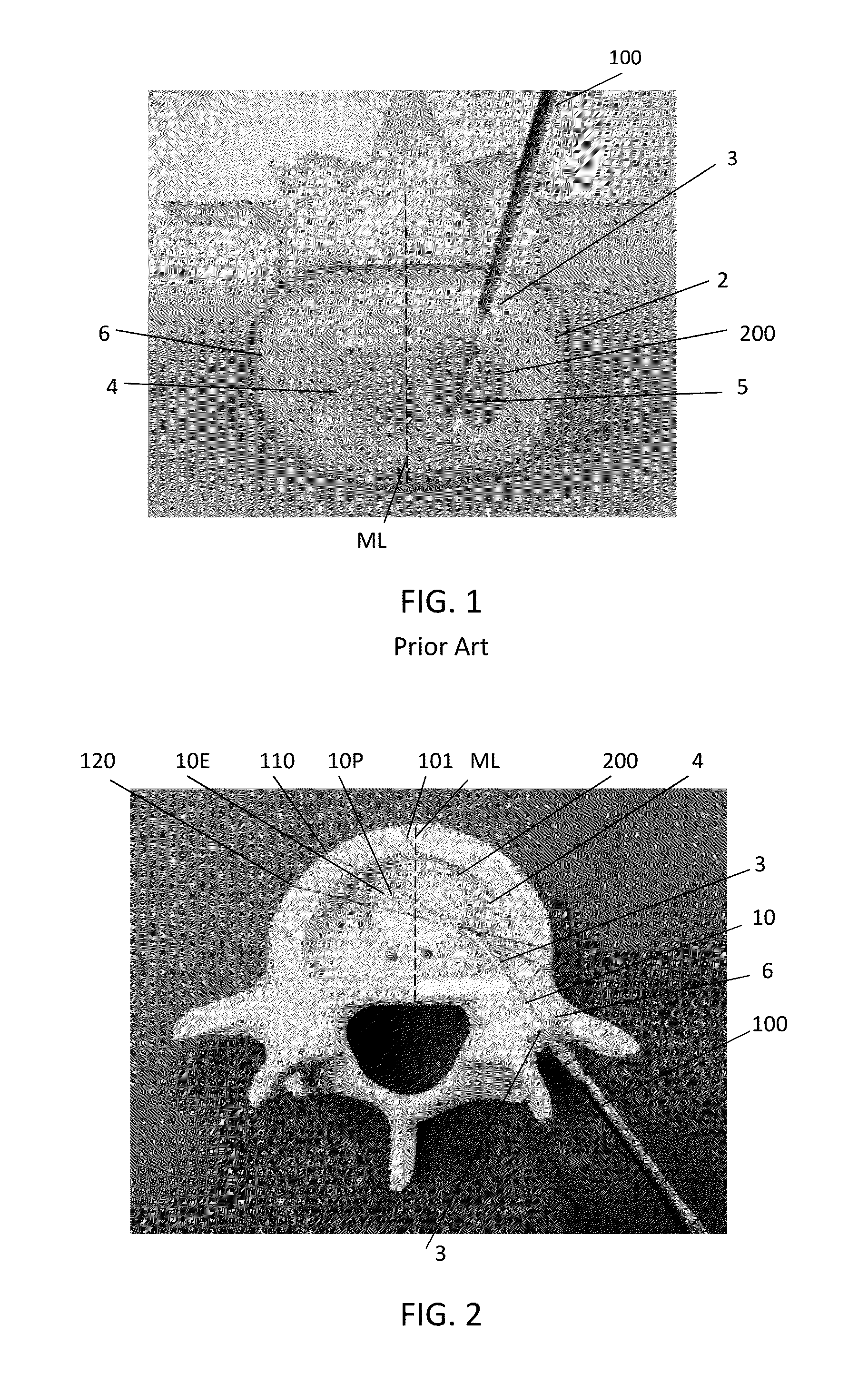 Tunneling device