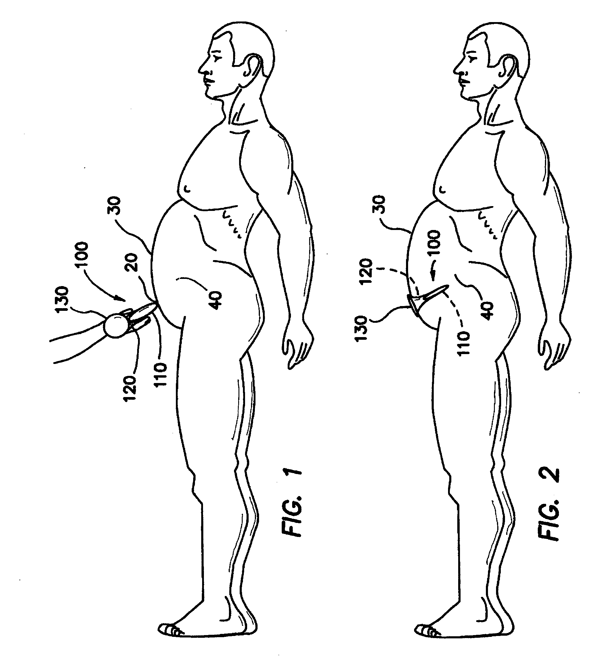 Easily placeable and removable wound retractor