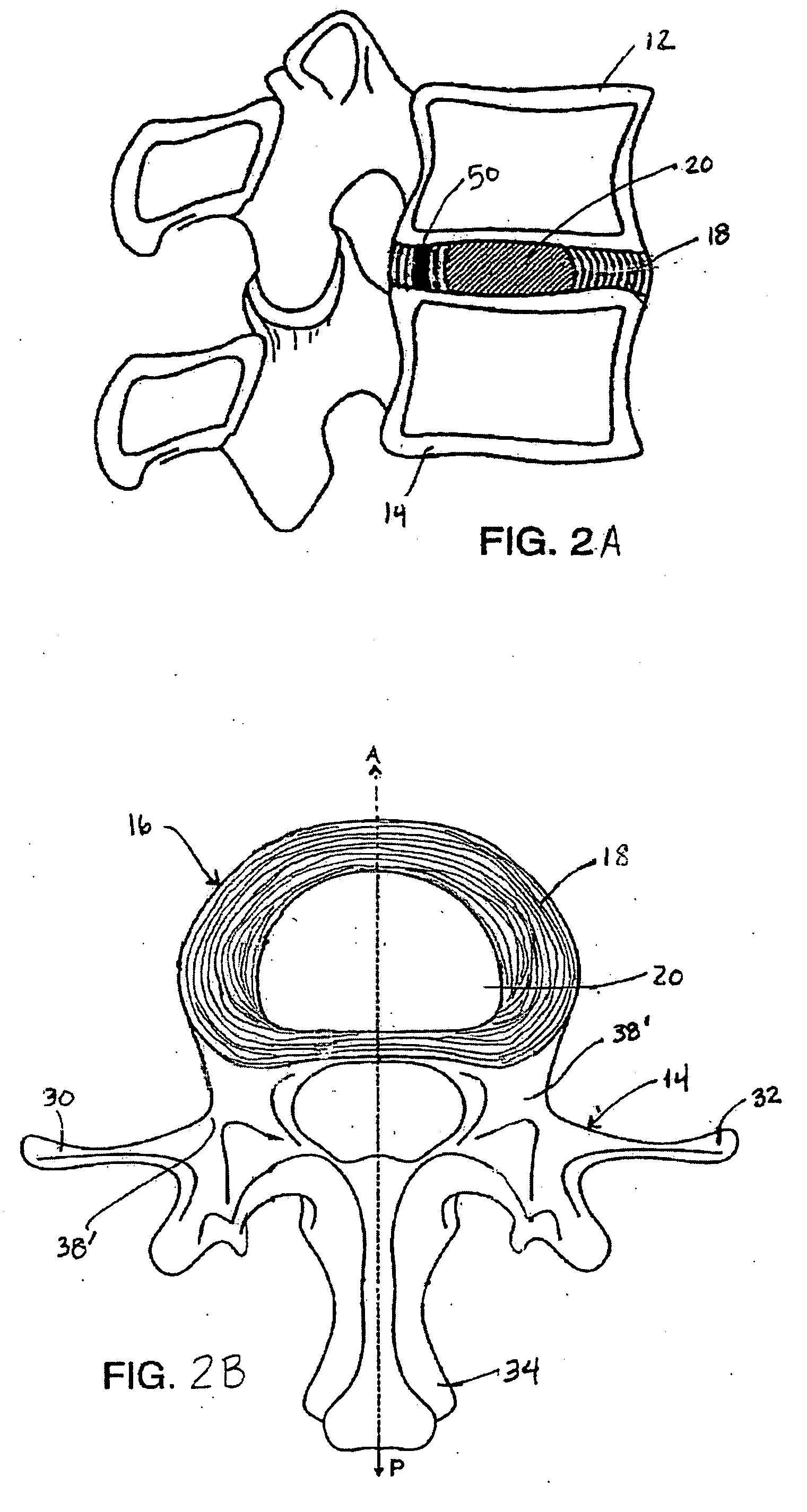 Spinal disc annulus augmentation