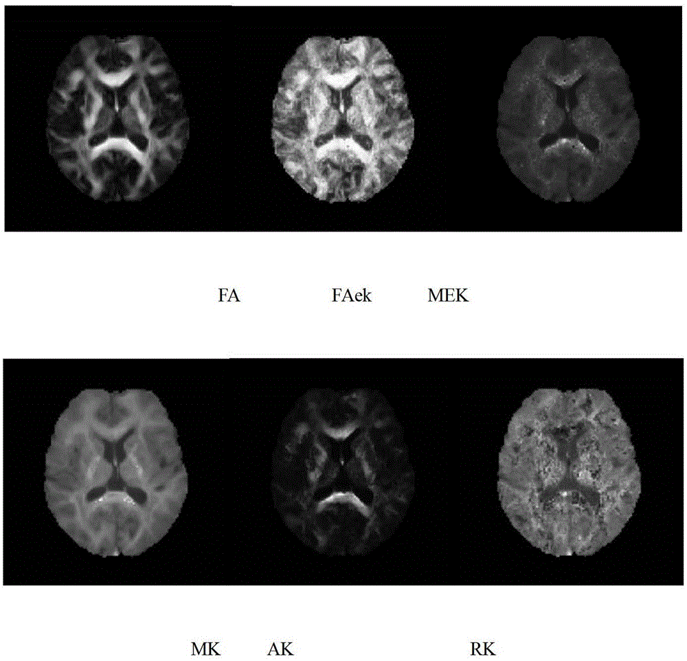 High-order Tensor Feature Parameters Extraction Method for Diffusion Kurtosis Tensor Imaging