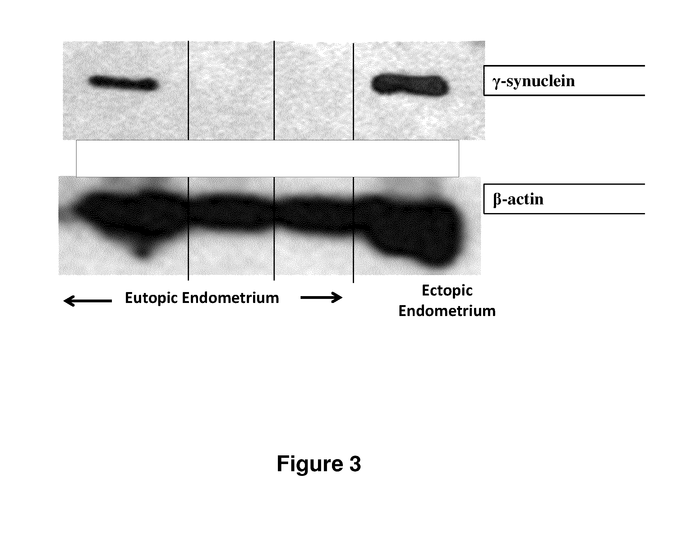 Treatment of endometriosis, angiogenesis and/or endometrial lesion growth