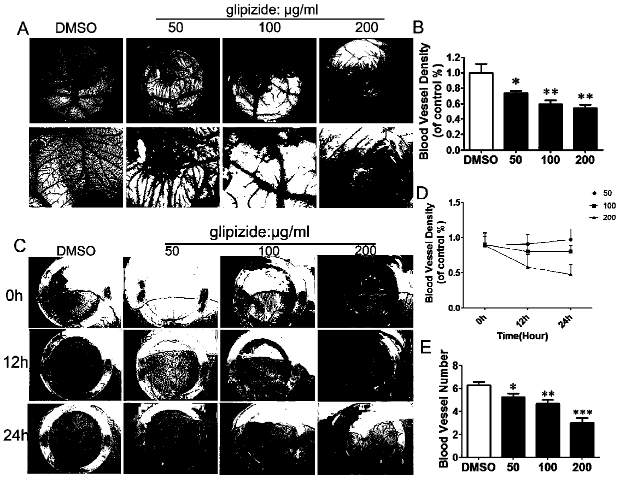 Application of glipizide in preparing medicine for treating tumors