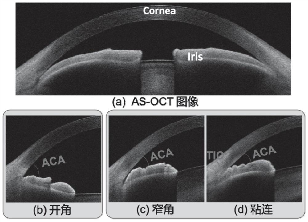 A method for angle classification of as-oct images based on convolutional recurrent neural network