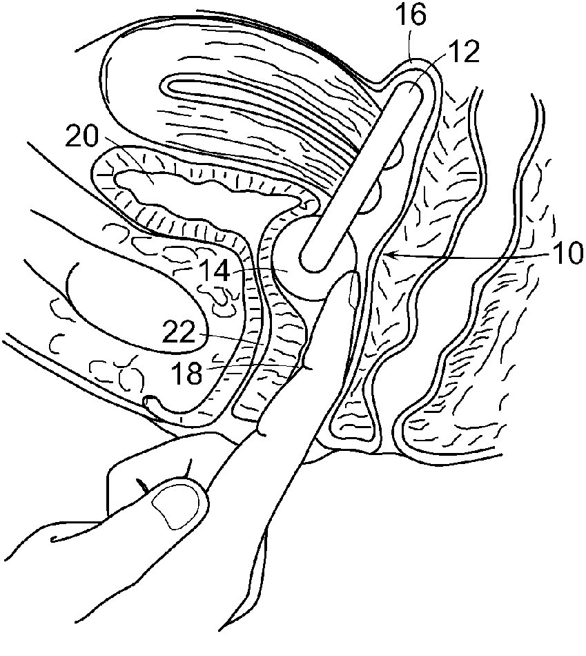 Correction of stress urinary incontinence