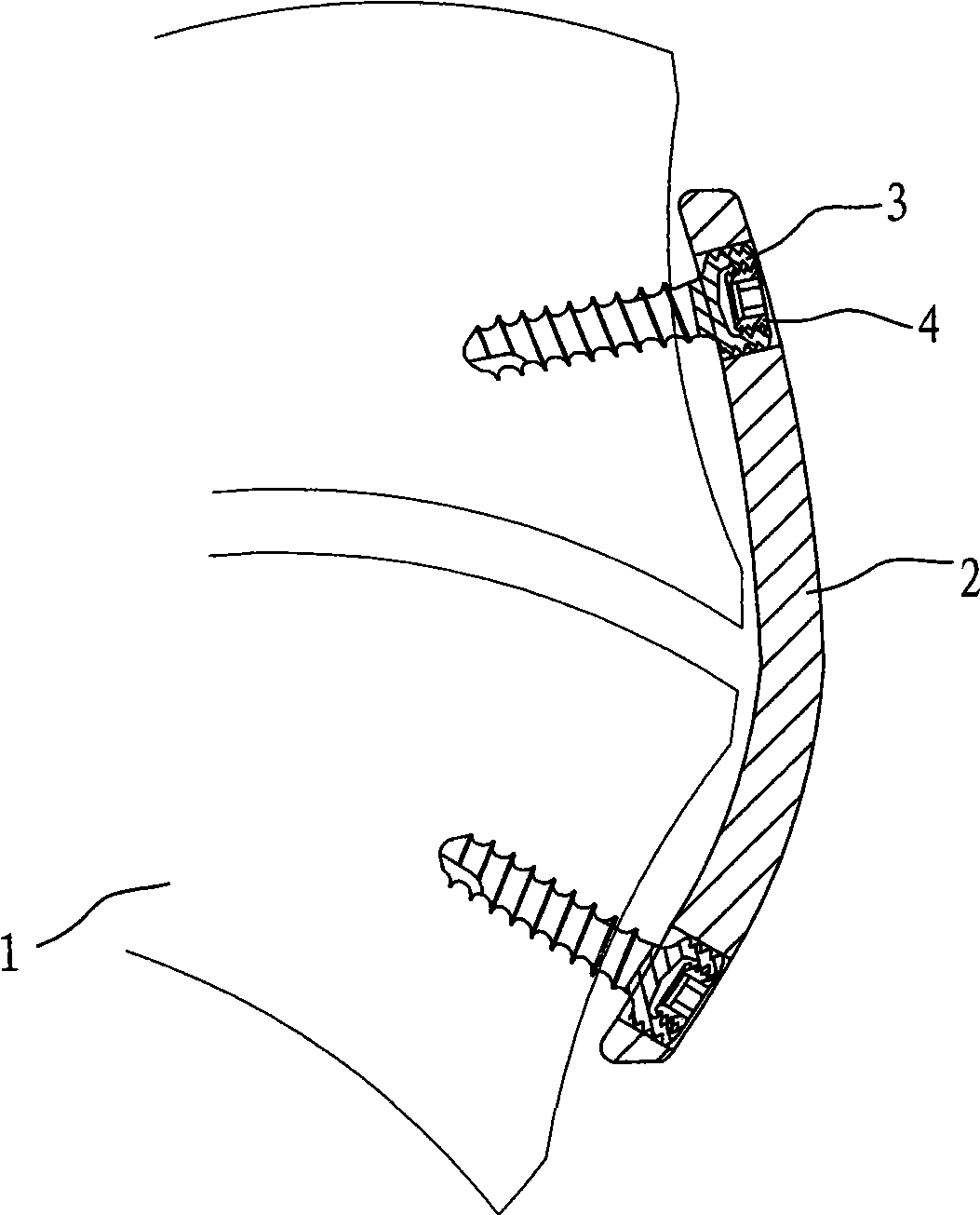 Minimally invasive dual-locking implantation system for cervical vertebra