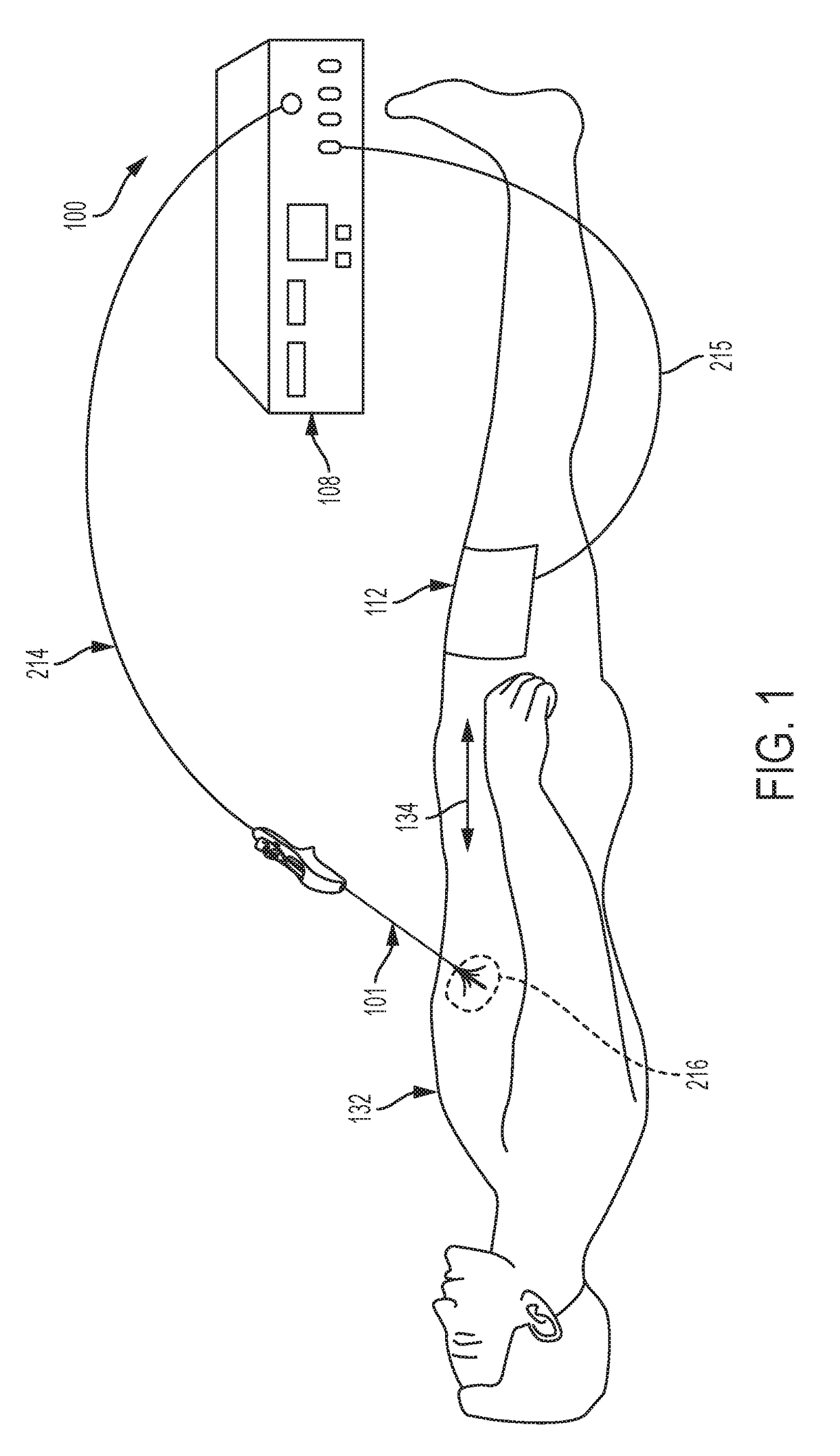 Techniques for irreversible electroporation using a single-pole tine-style internal device communicating with an external surface electrode