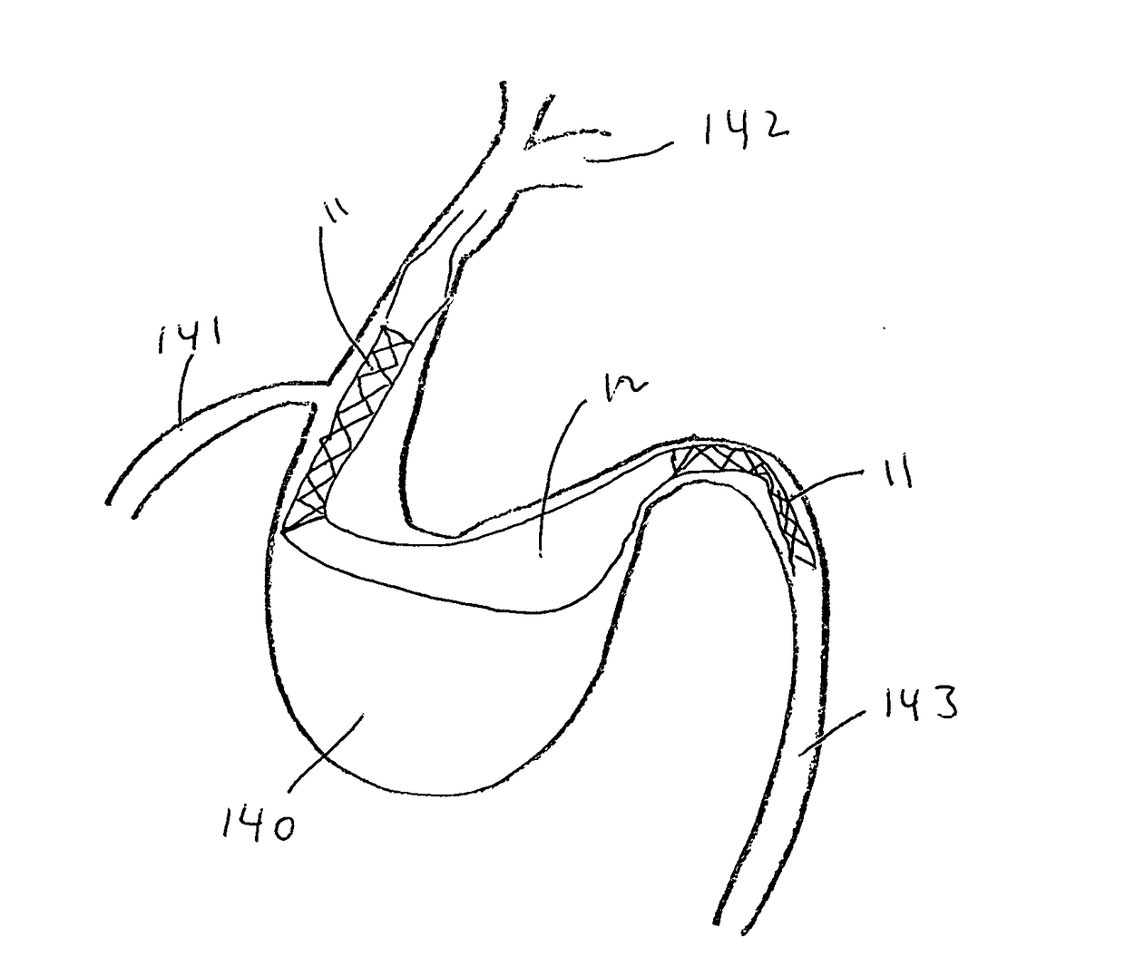 Stent