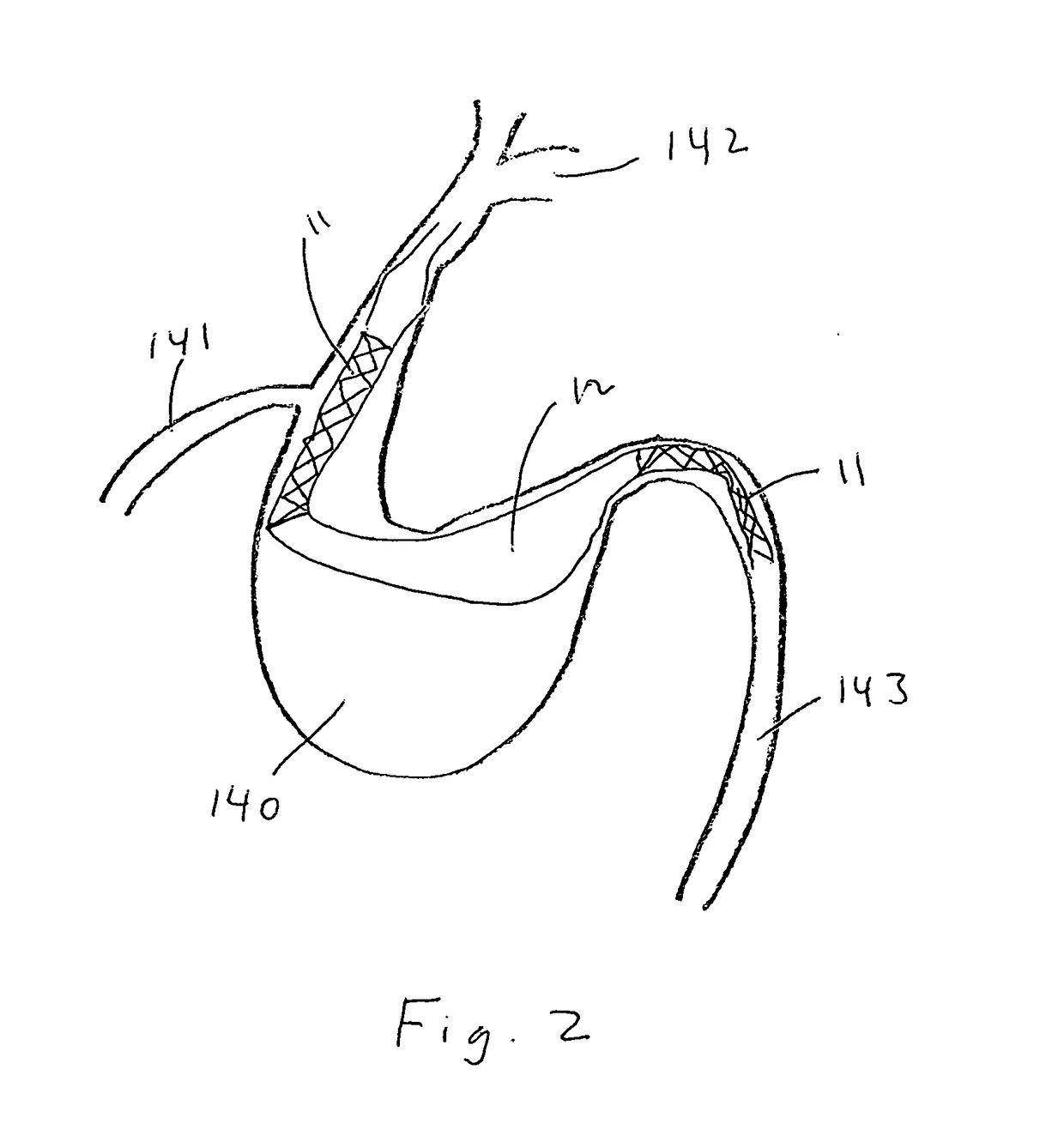 Stent