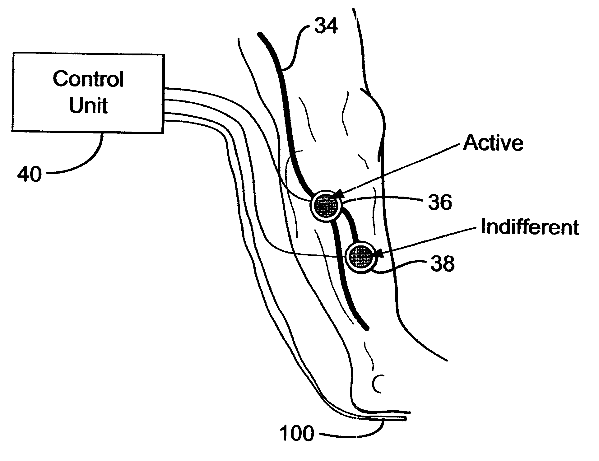 Apparatus for electrical stimulation of the body