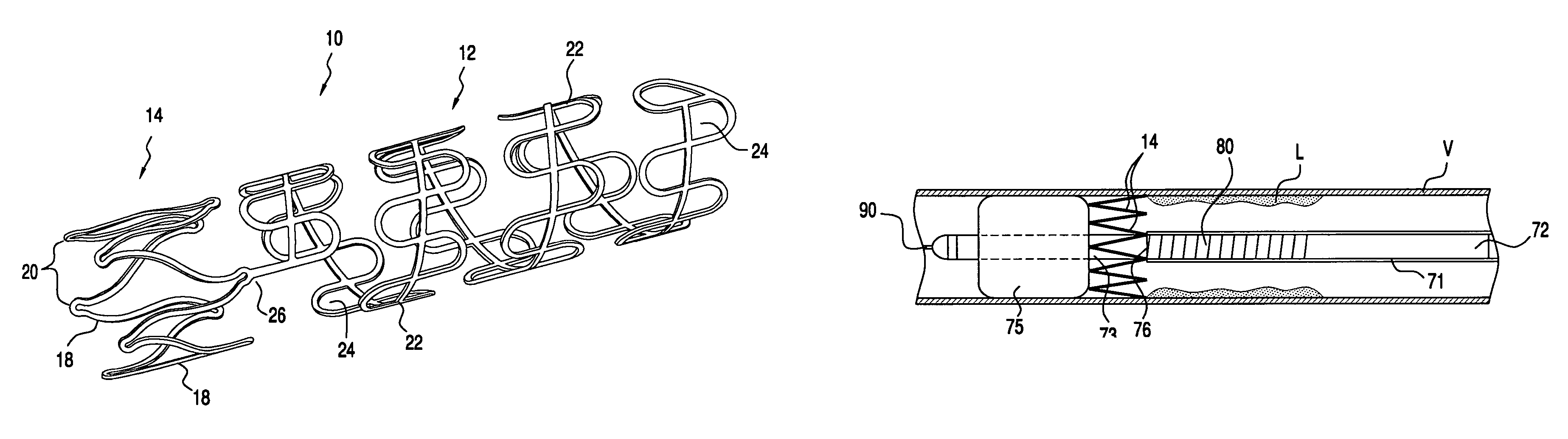 Delivery catheter that controls foreshortening of ribbon-type prostheses and methods of making and use