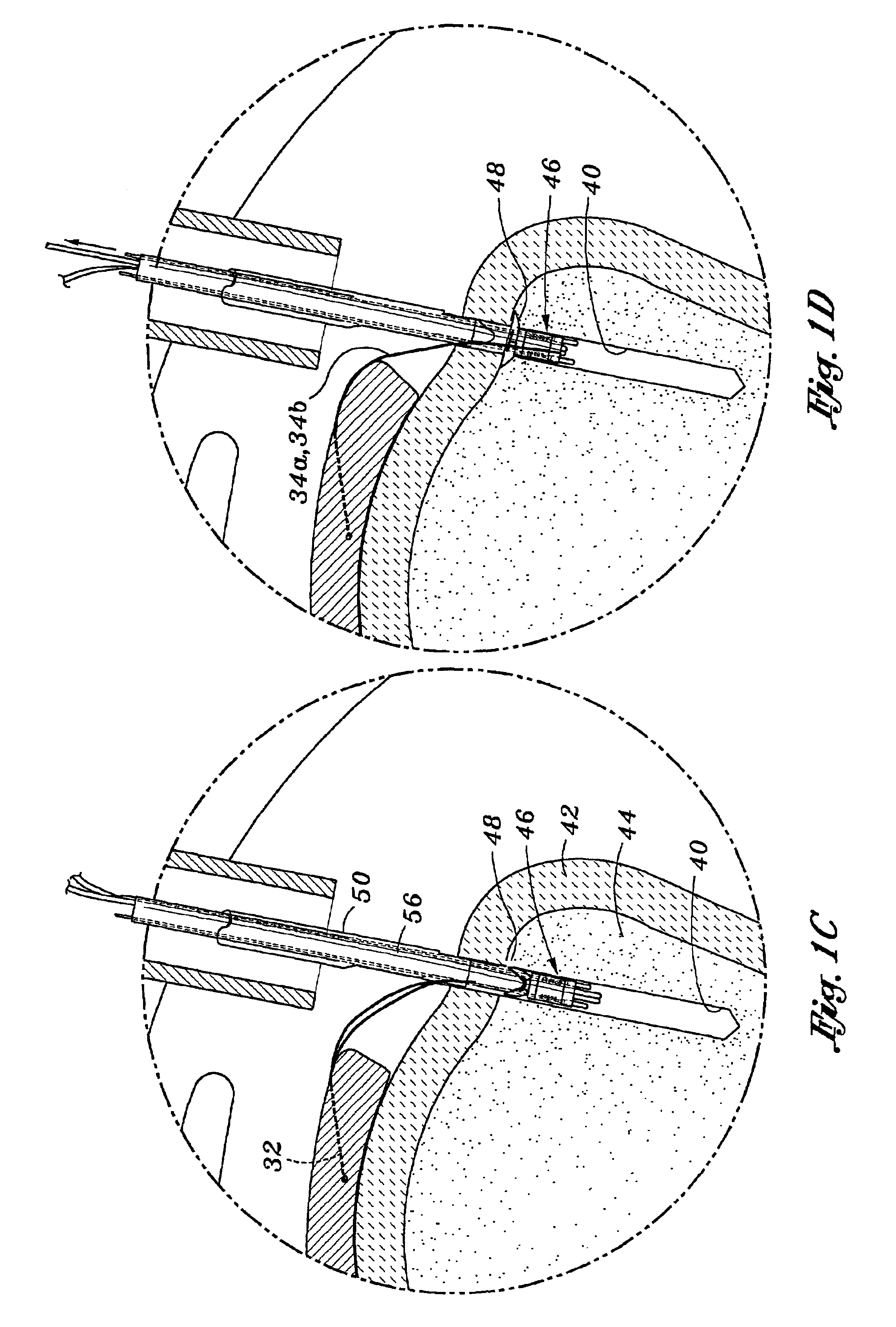 Method and apparatus for attaching connective tissues to bone using a knotless suture anchoring device