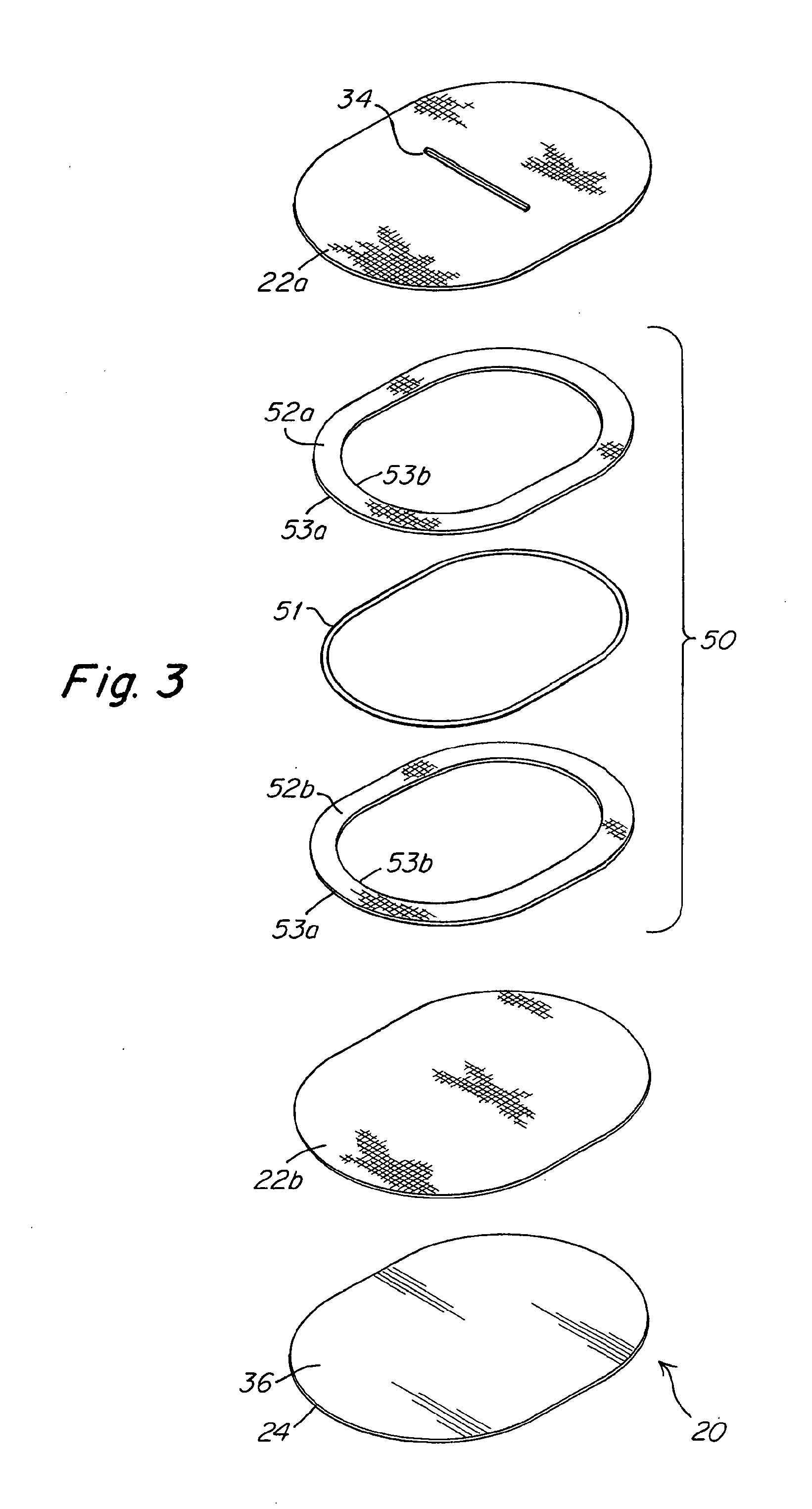 Implantable prosthesis