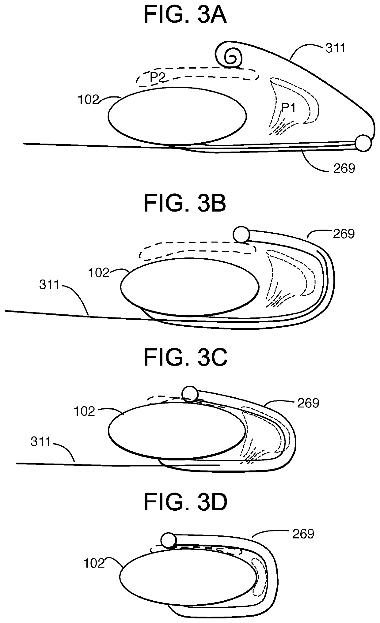 Distal subannular anchoring tab for side-delivered transcatheter valve prosthesis