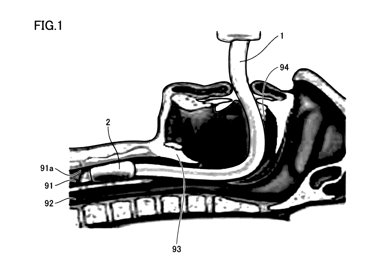 Cuff-pressure control device, cuffed tracheal tube, respirator, and obstruction detection method