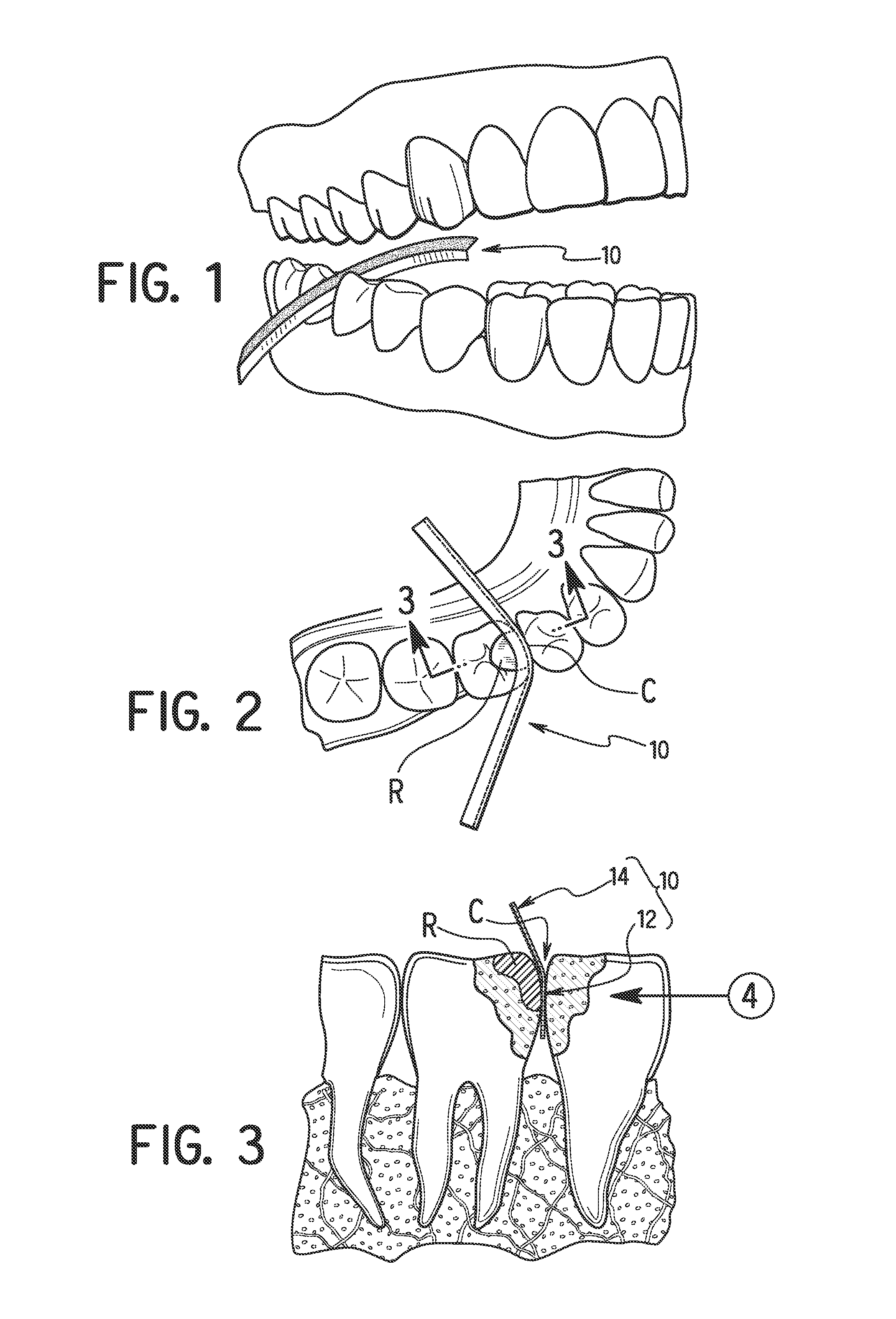 Dental shaping strip