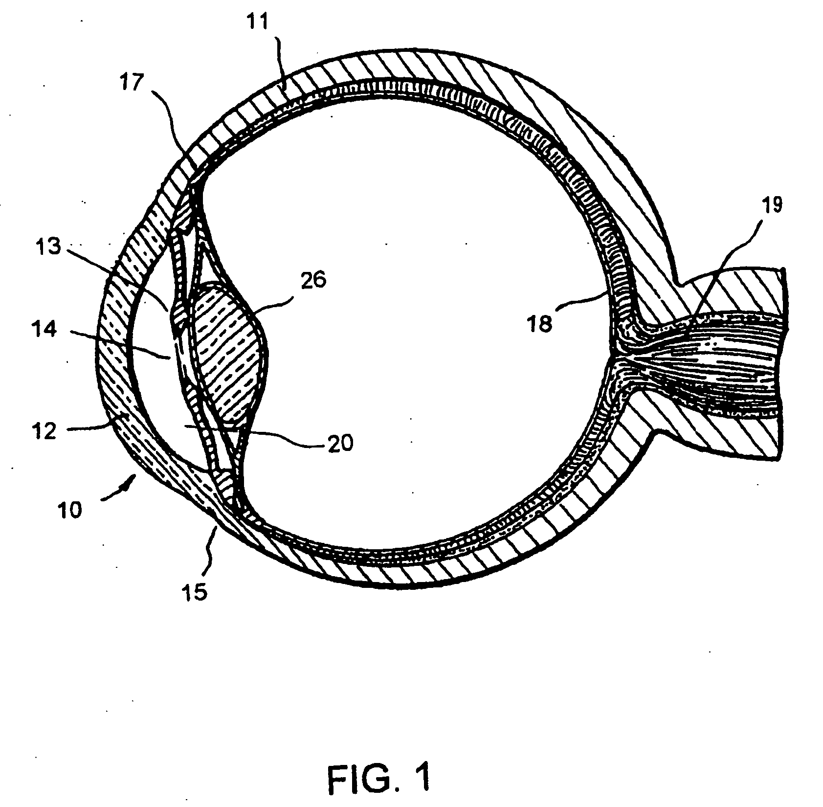 Liquid jet for glaucoma treatment