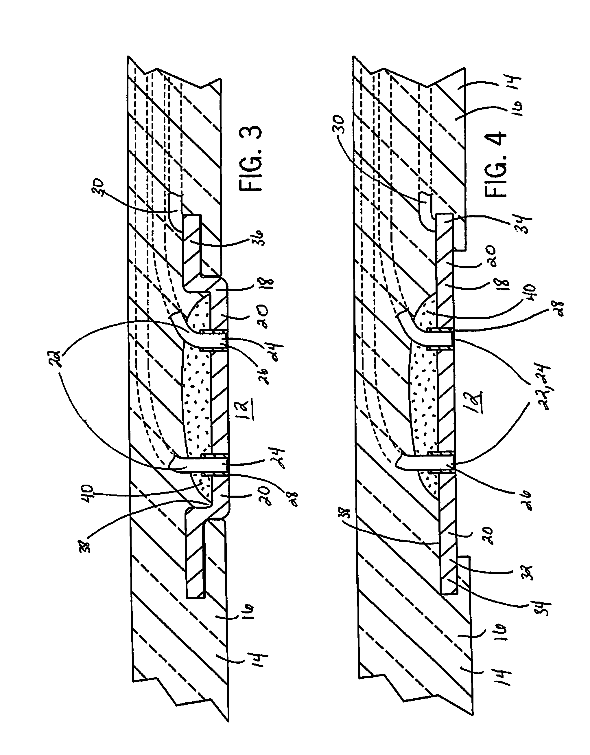 Intracranial sensing and monitoring device with macro and micro electrodes