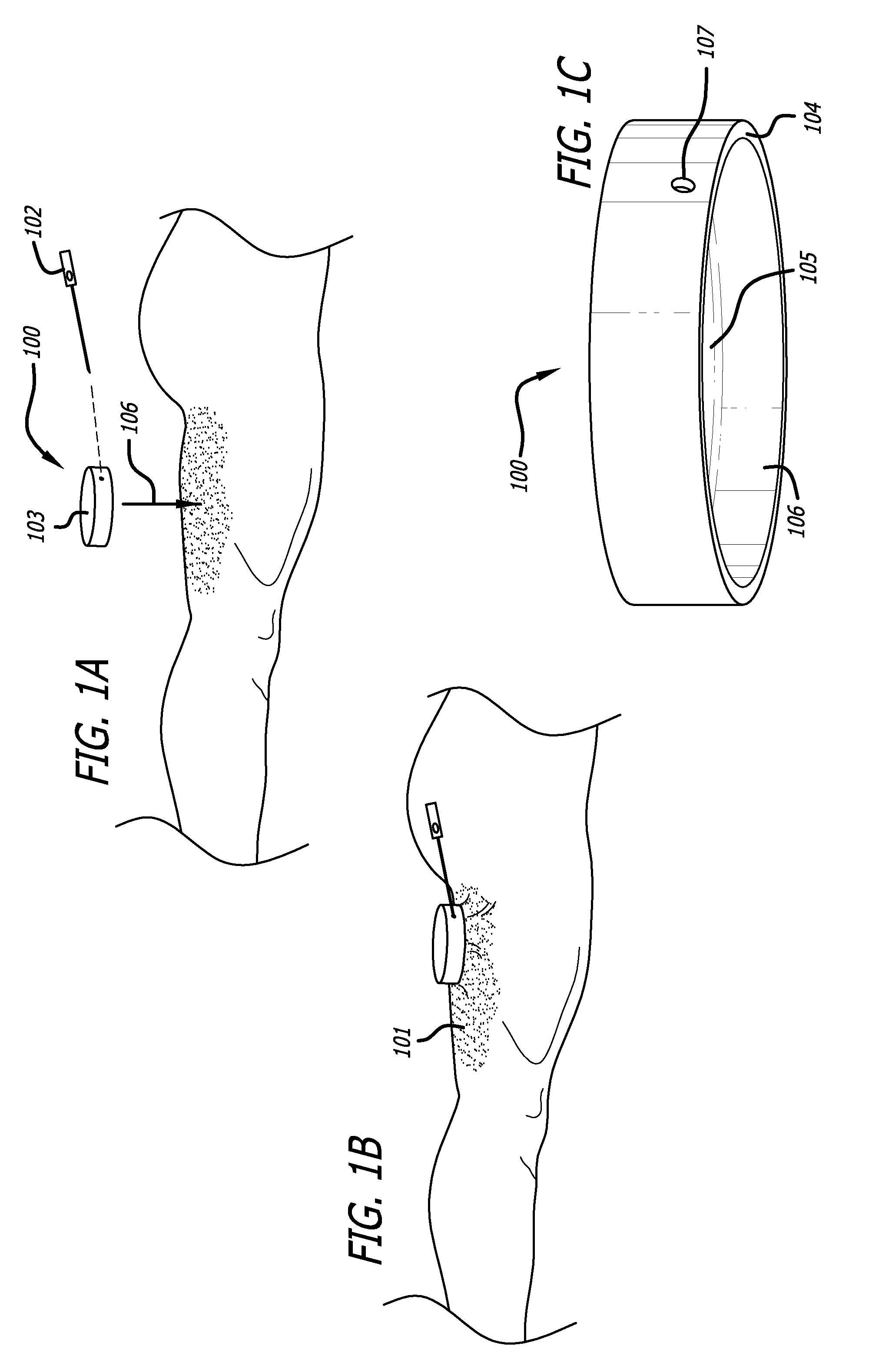 Dissection handpiece and method for reducing the appearance of cellulite