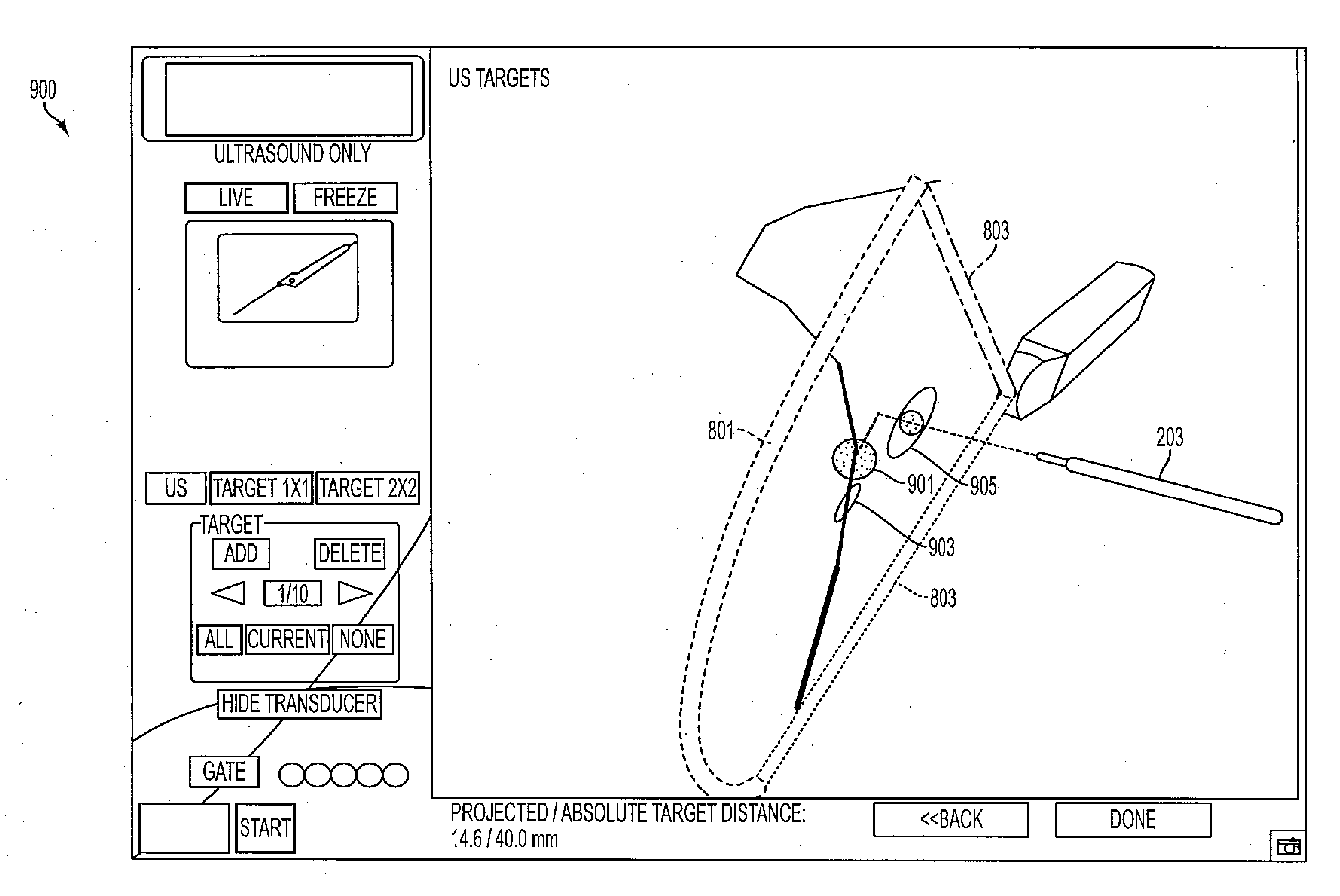 Method, system and devices for transjugular intrahepatic portosystemic shunt (TIPS) procedures