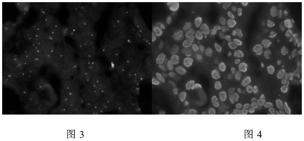 Cancer cell her2 gene amplification analysis method and system