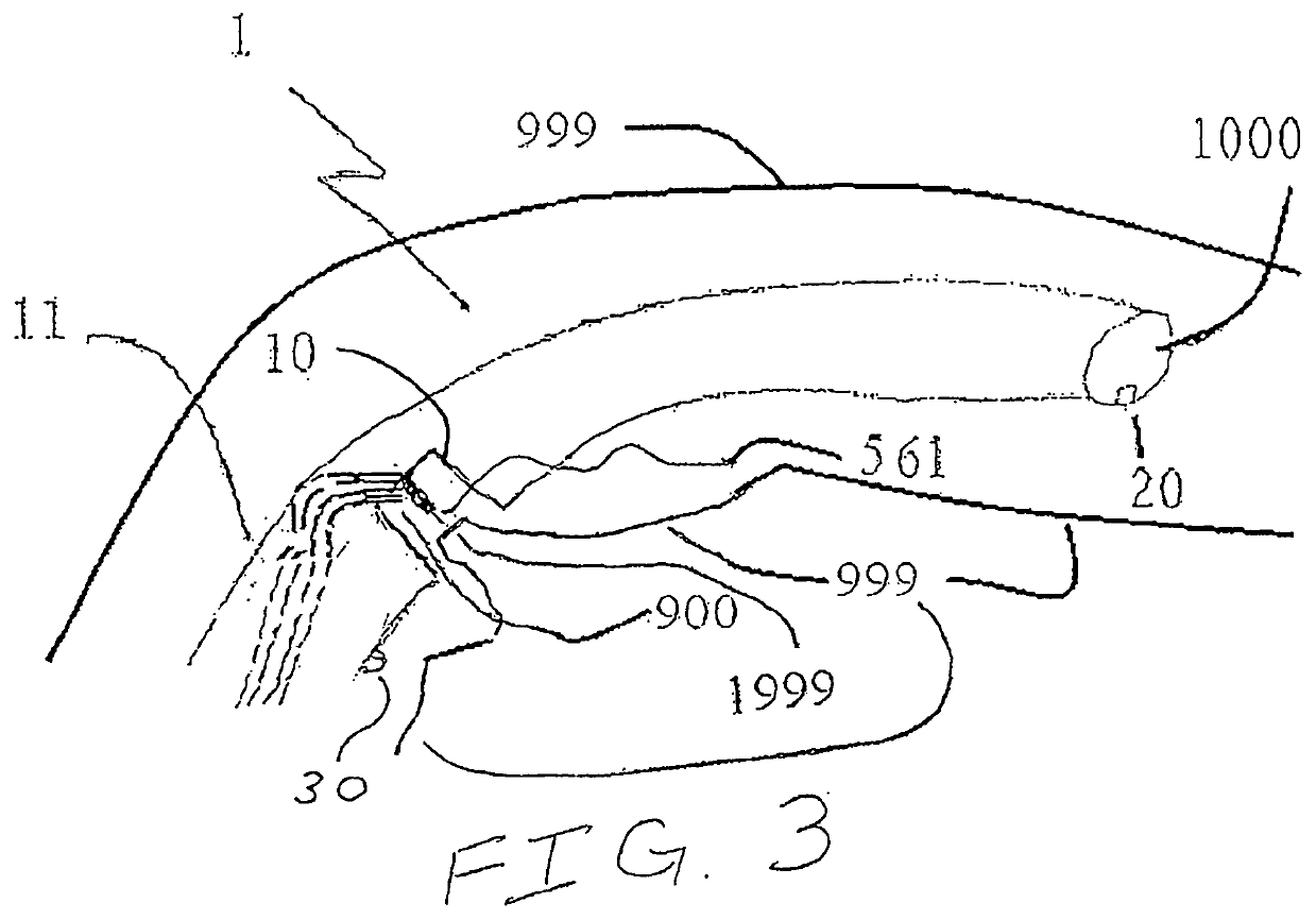 Osteotomy Device