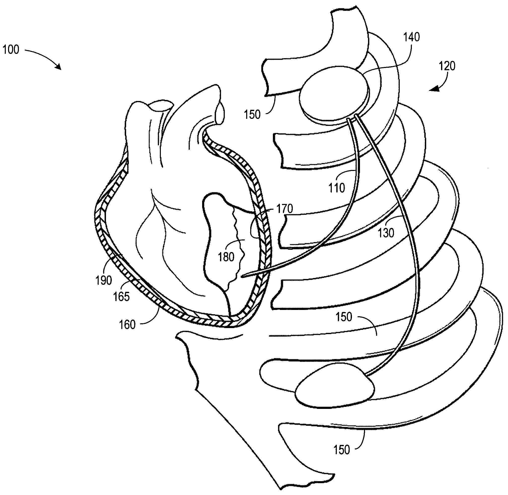 Sensor guided epicardial lead