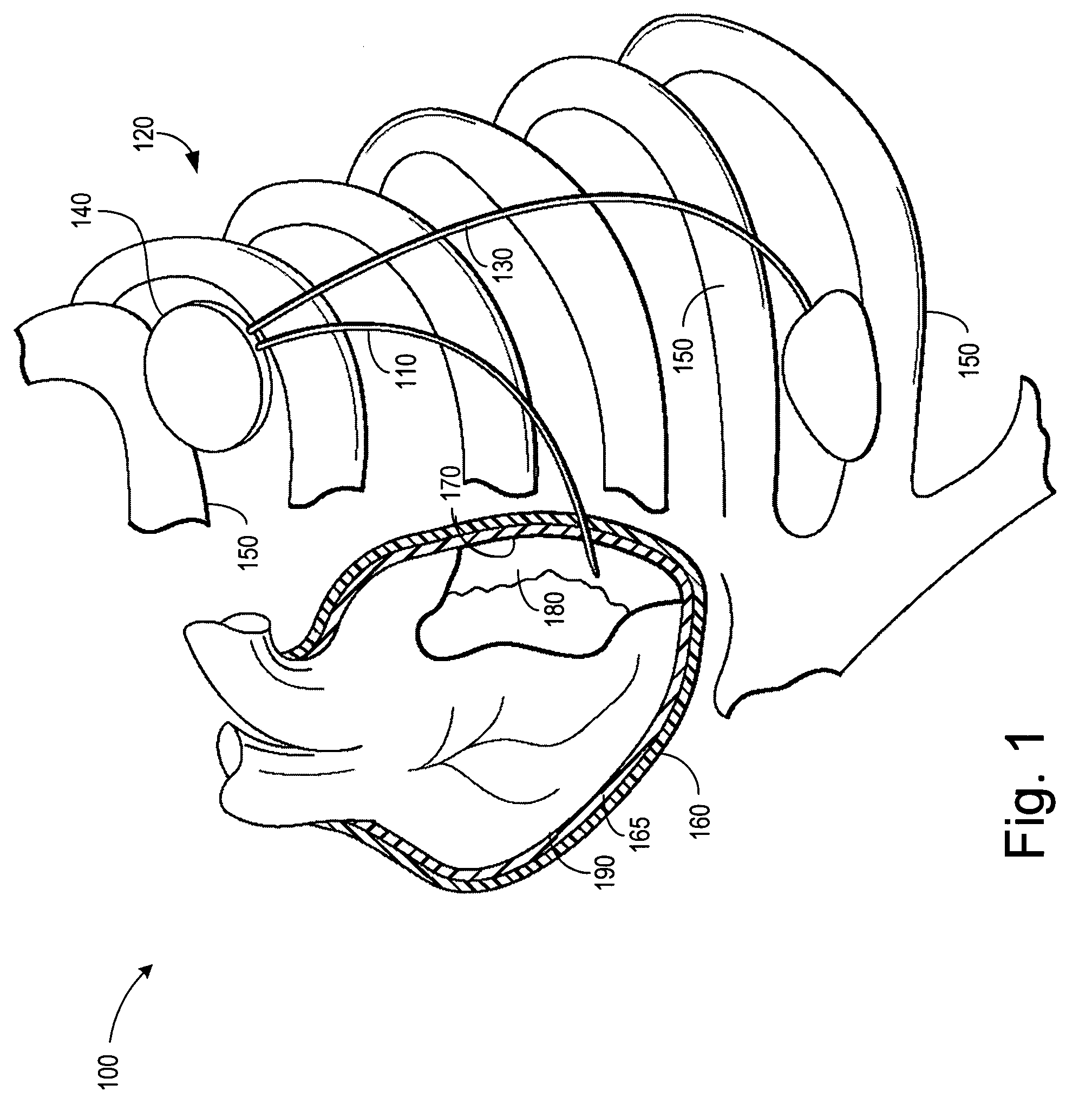 Sensor guided epicardial lead