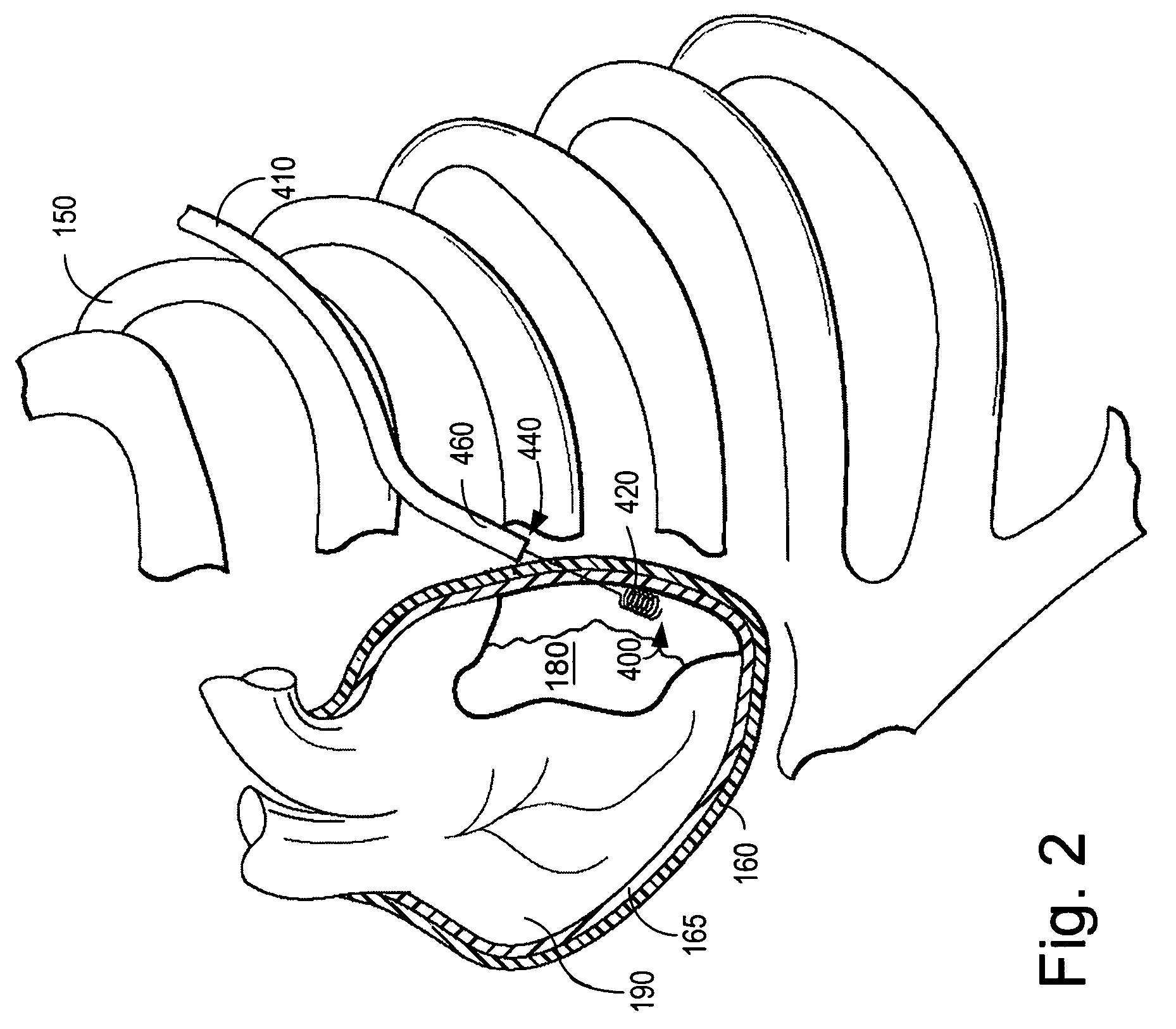 Sensor guided epicardial lead